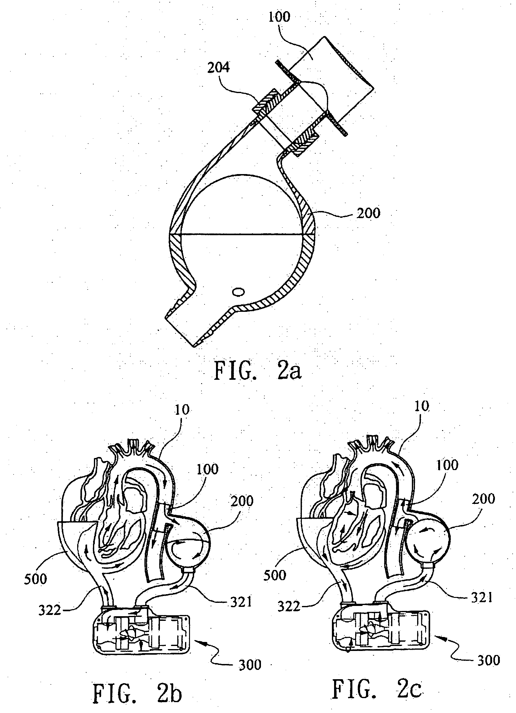 Ventricular Assist Device