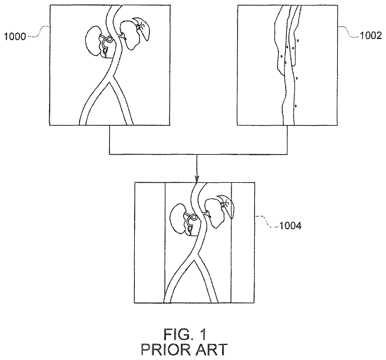 Combination of 3D ultrasound and computed tomography for guidance in interventional medical procedures