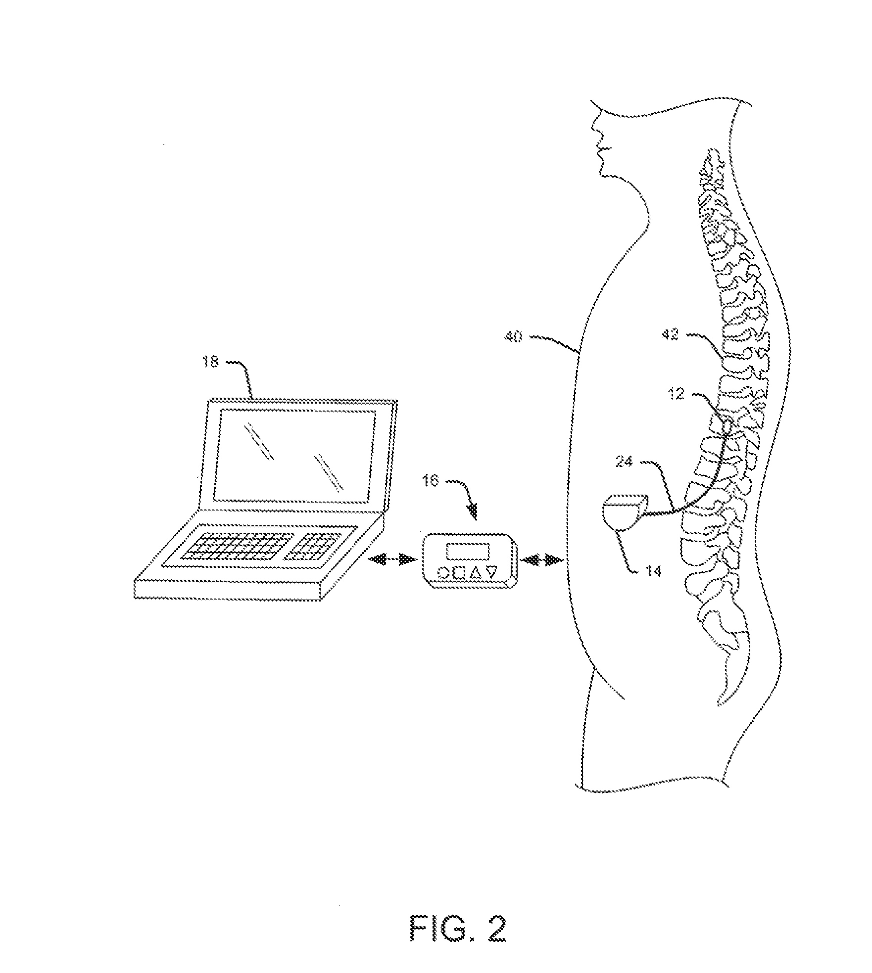 System and method for stimulating intraosseous nerve fibers