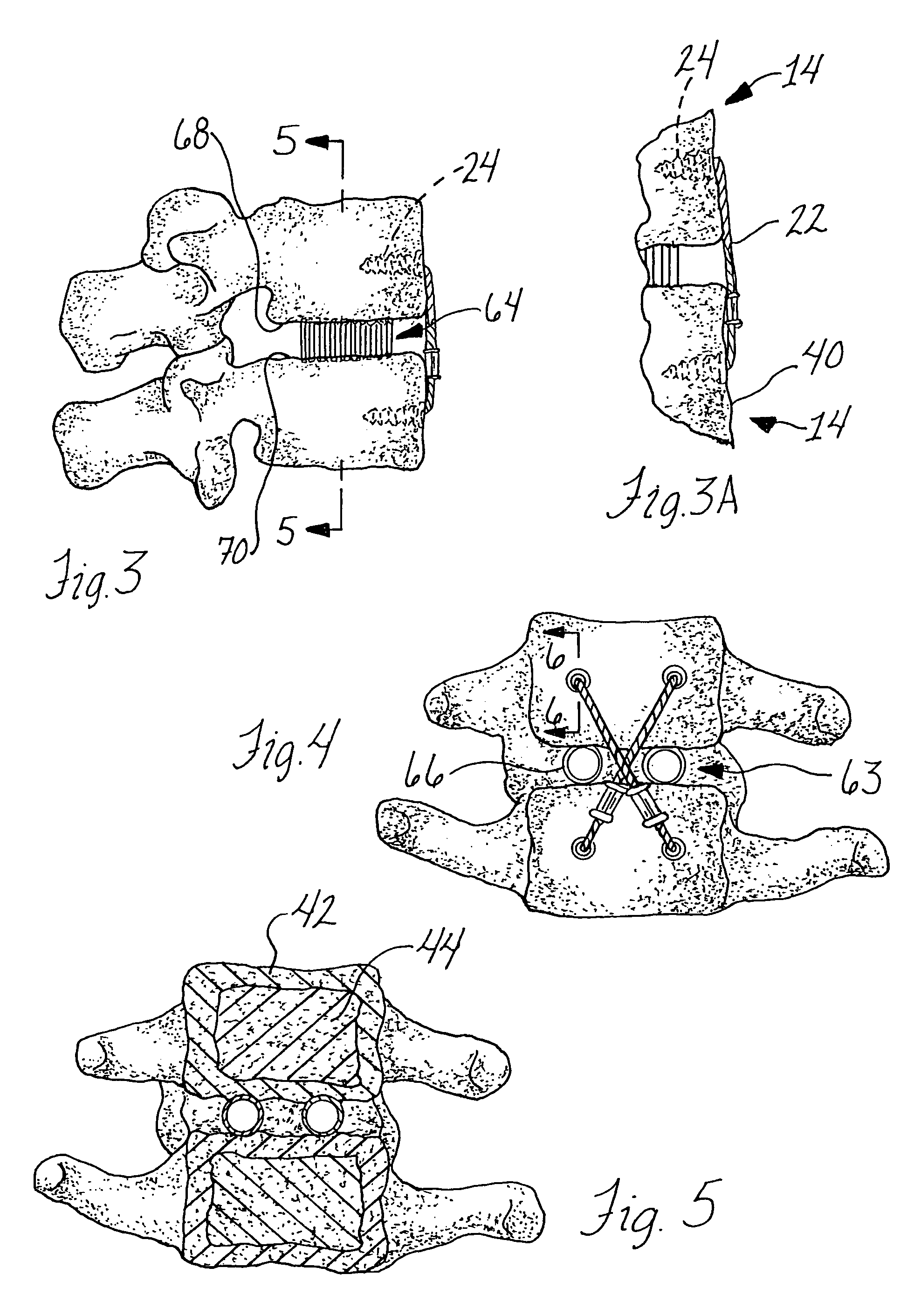 System and method for bone fixation