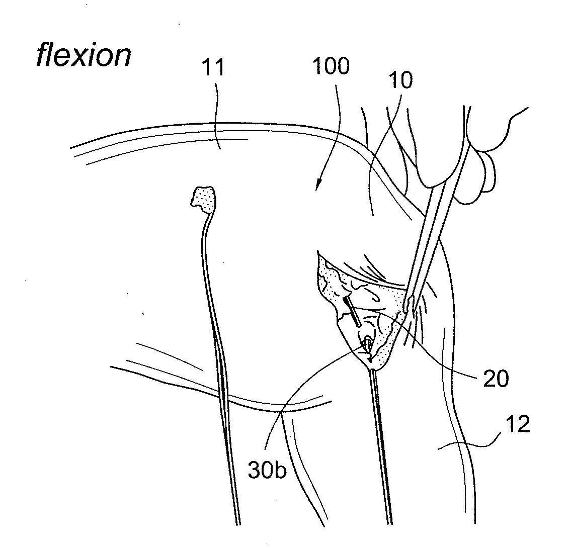 Internal brace for tissue repairs and reinforcements