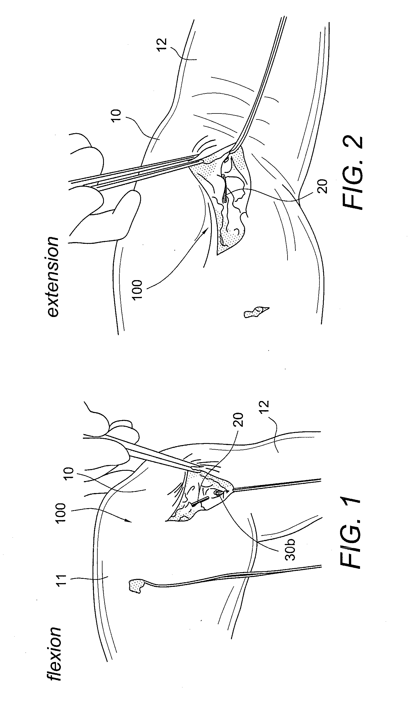 Internal brace for tissue repairs and reinforcements