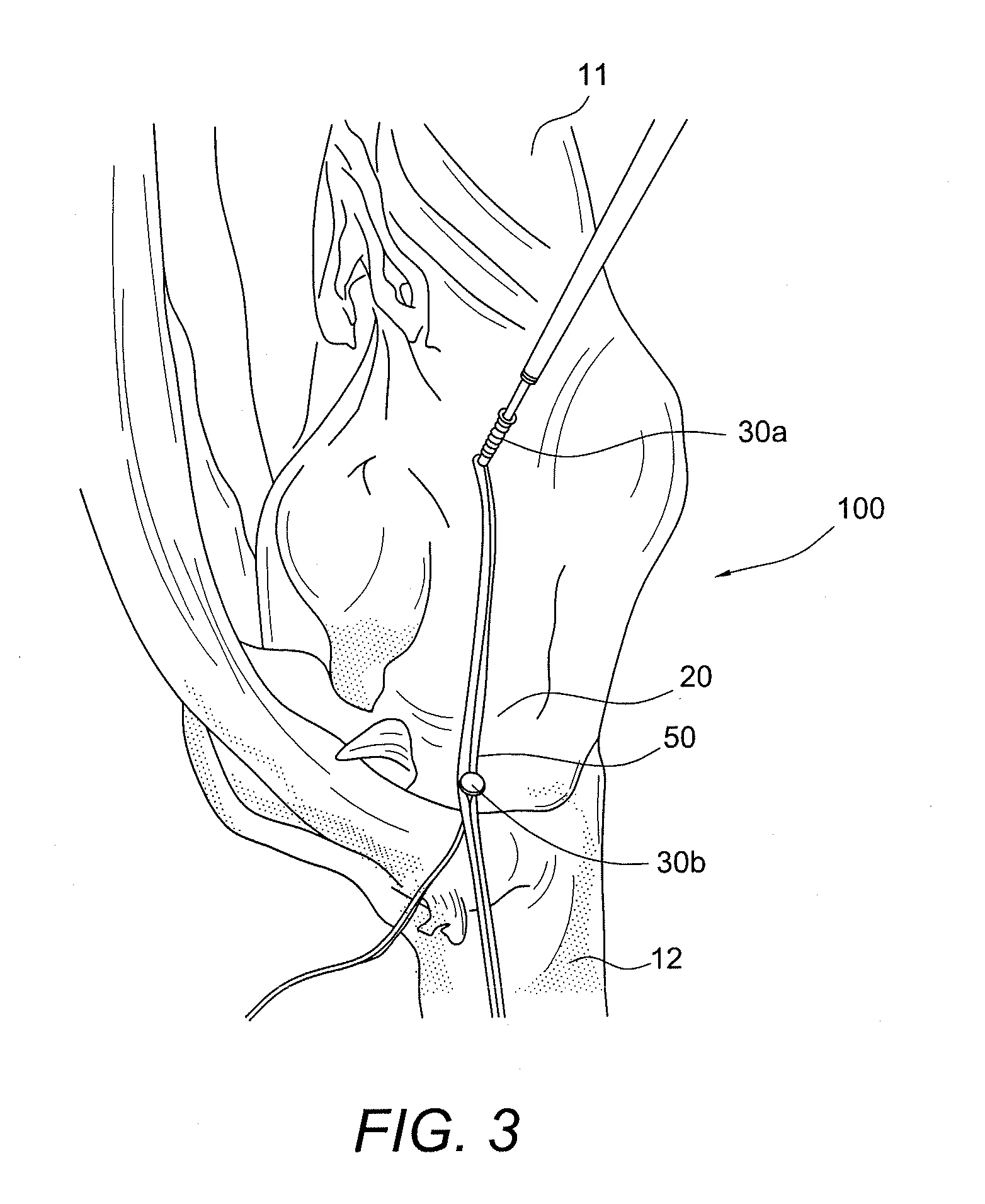 Internal brace for tissue repairs and reinforcements