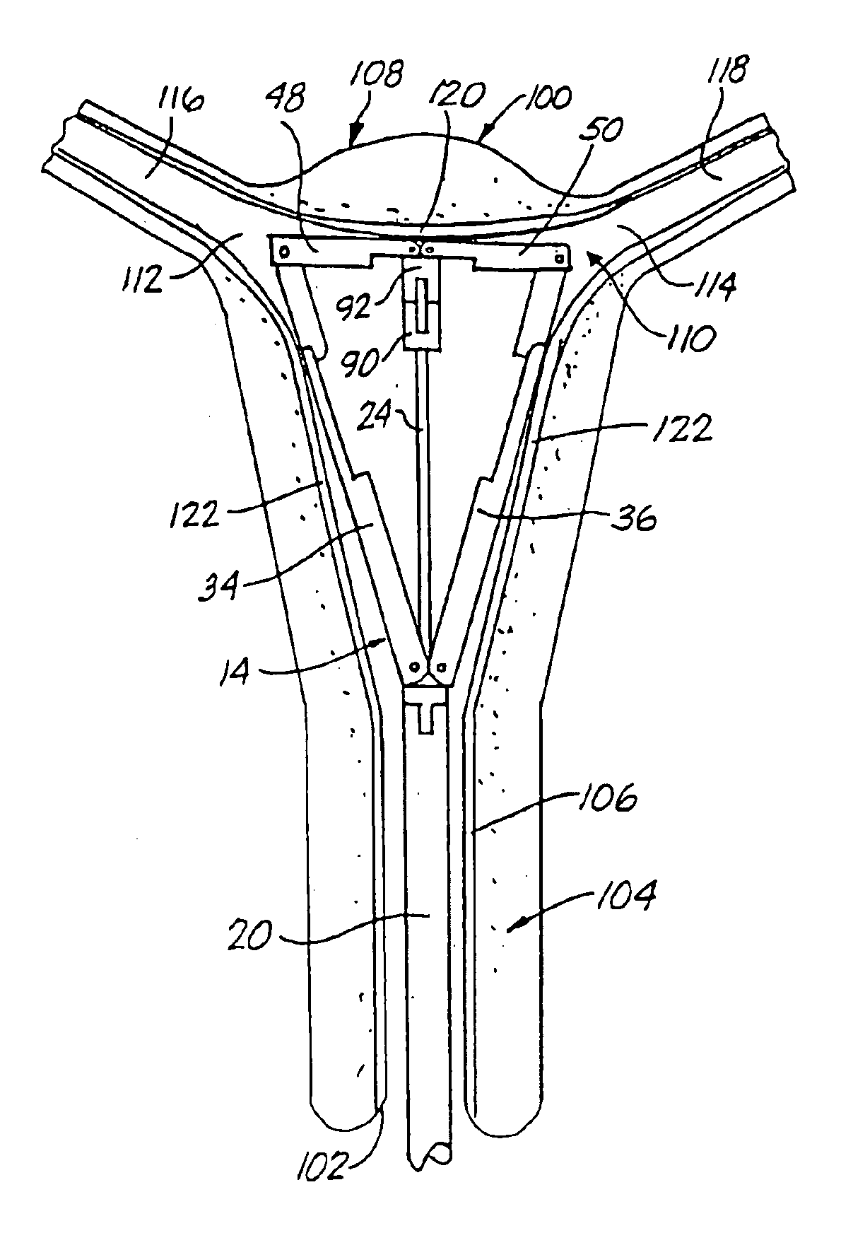 RF device for treating the uterus
