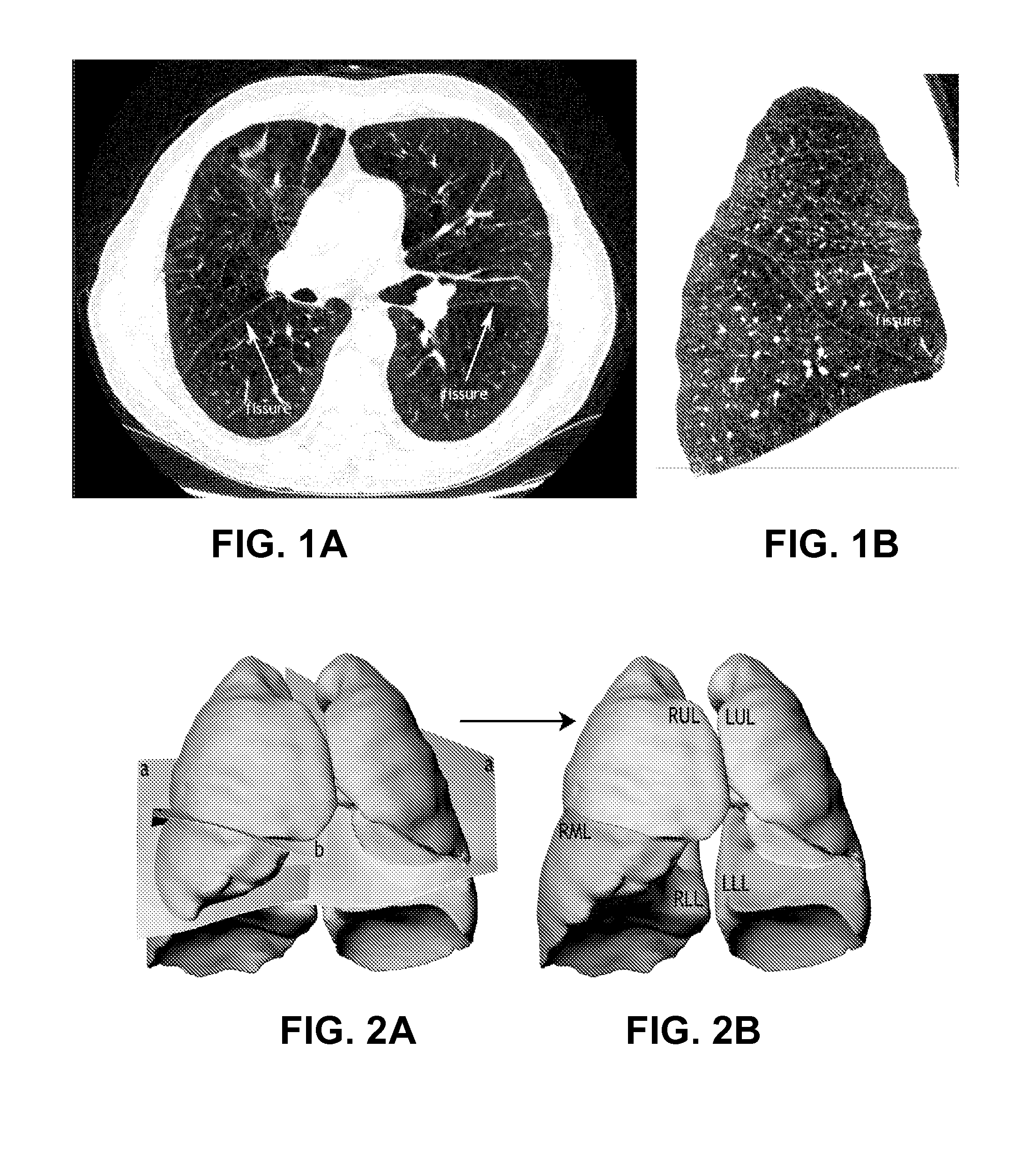 Method for determining treatments using patient-specific lung models and computer methods
