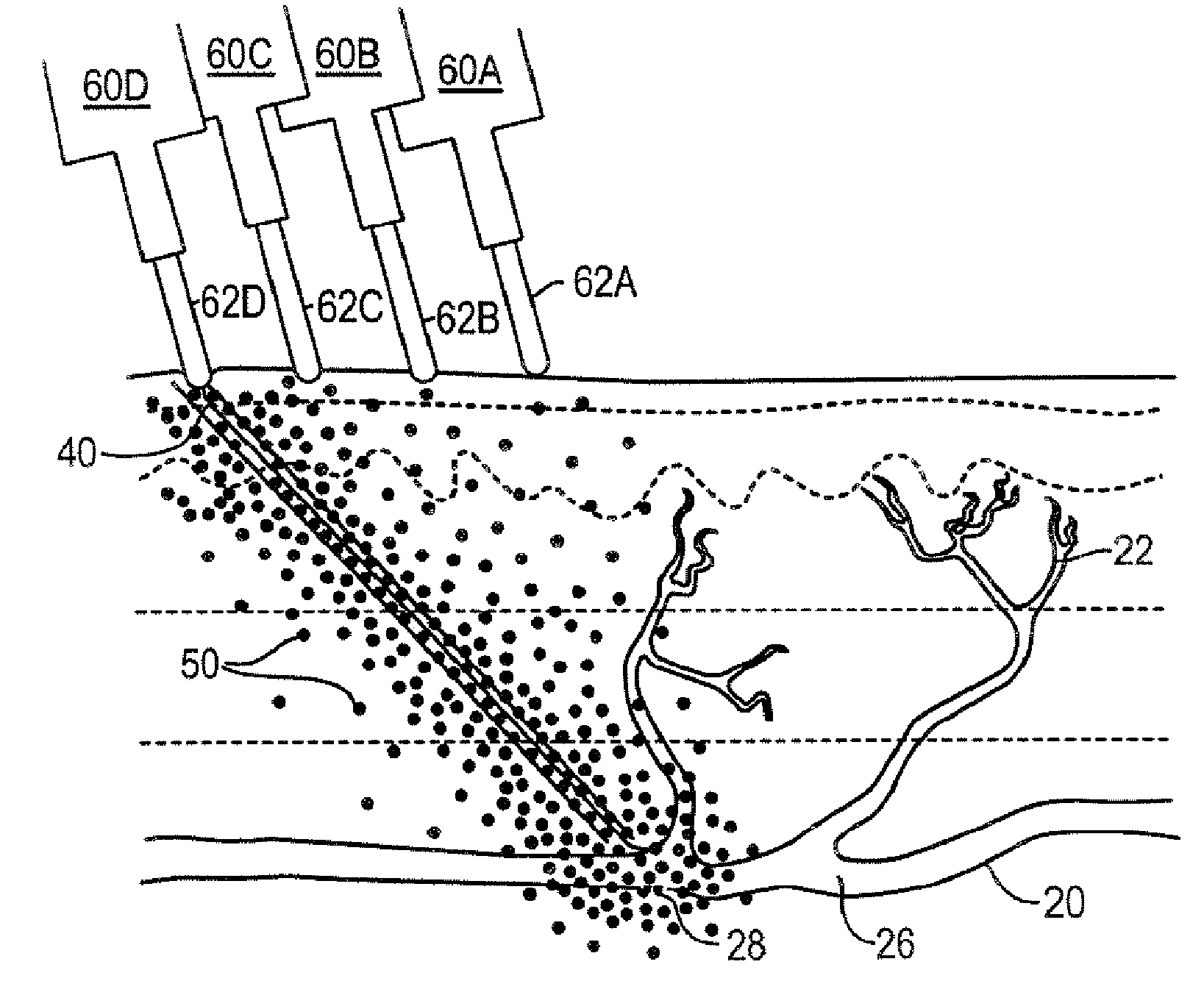 Cosmetic method and kit for treatment of spider veins and other superficial venous pathology