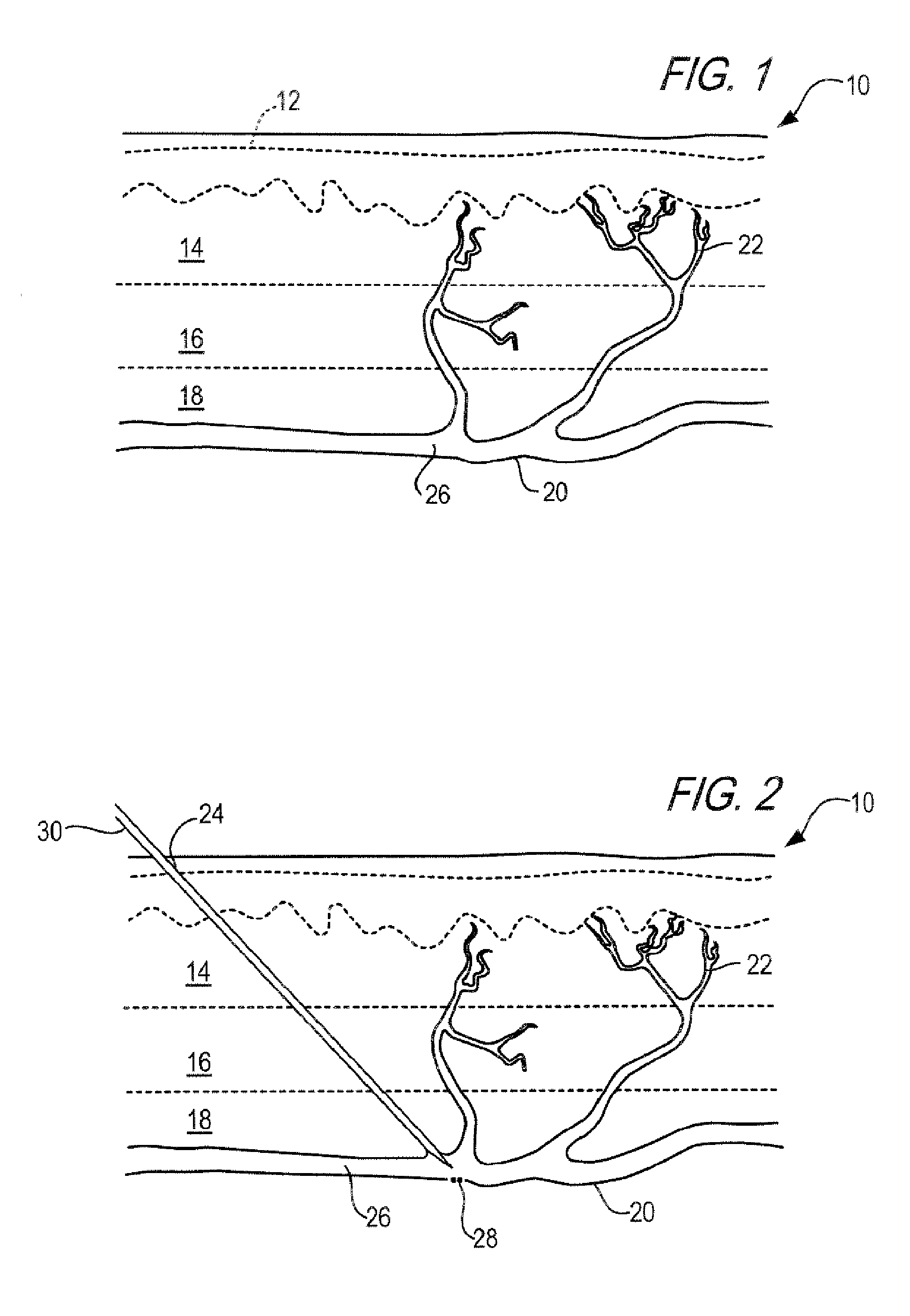 Cosmetic method and kit for treatment of spider veins and other superficial venous pathology