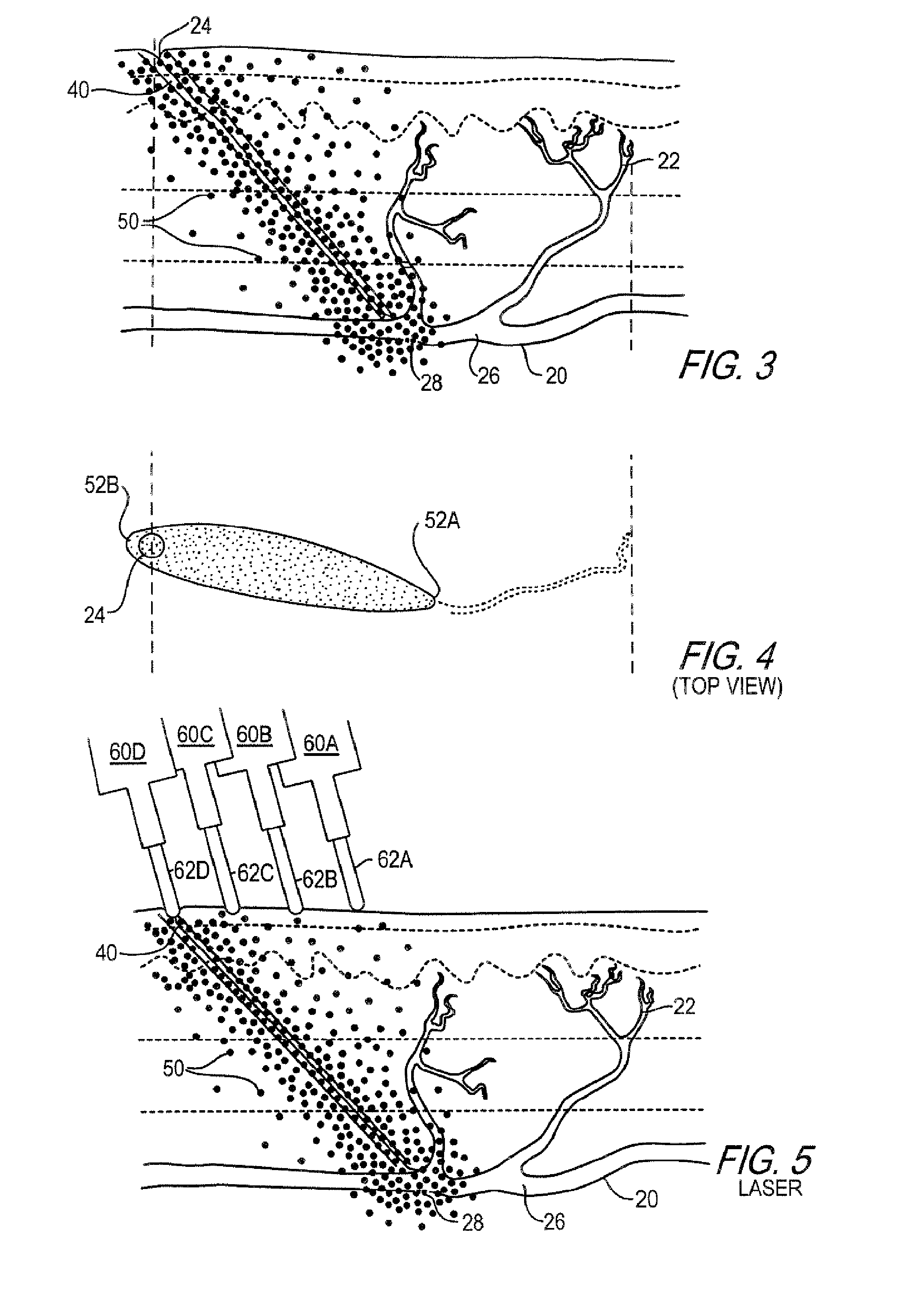 Cosmetic method and kit for treatment of spider veins and other superficial venous pathology