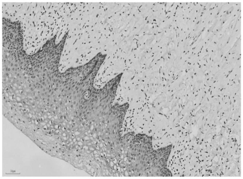 Application of protease activated receptor 2 as cervical cancer metastasis detection marker