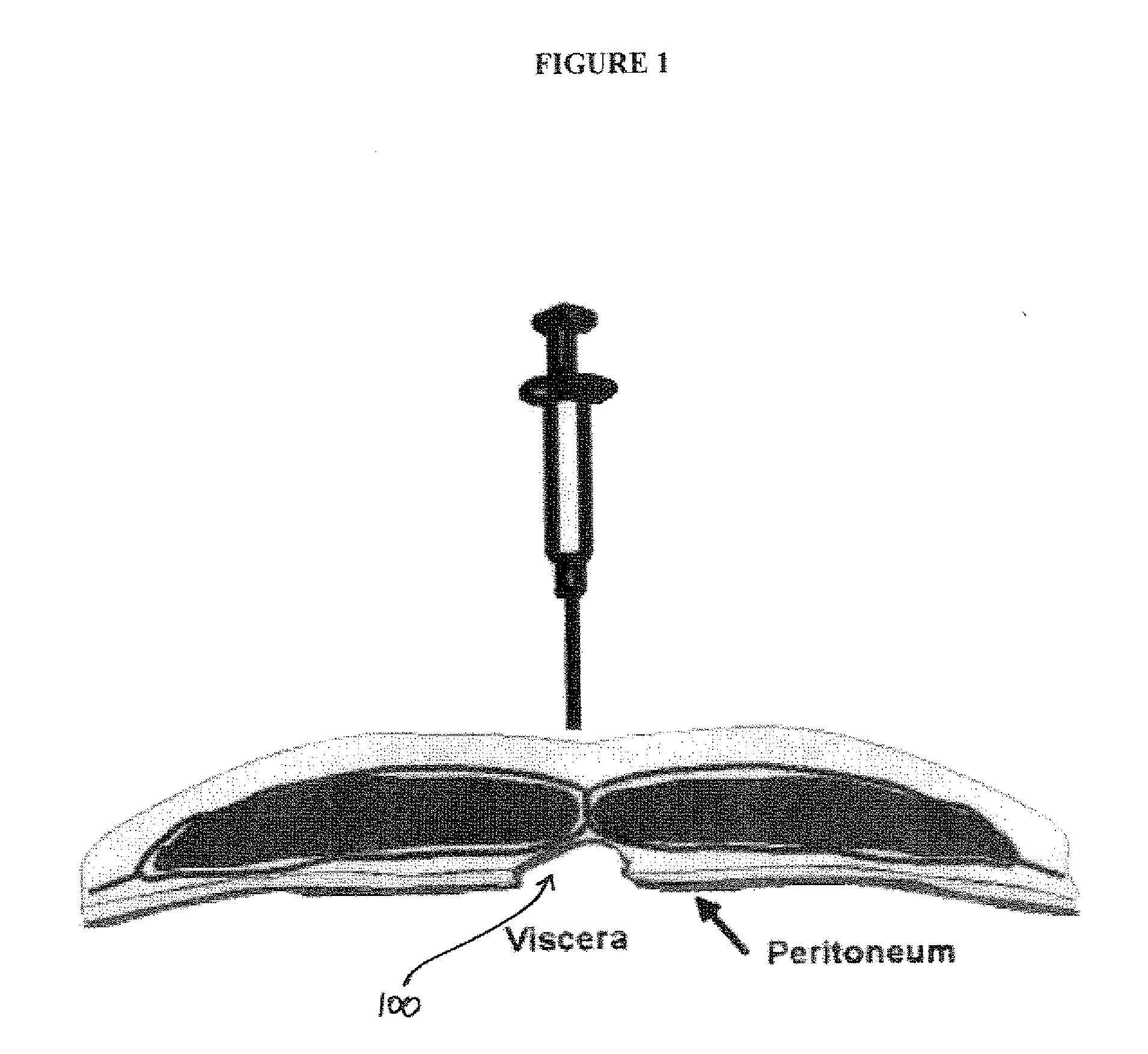 Composition and Method For Treating Tissue Defects