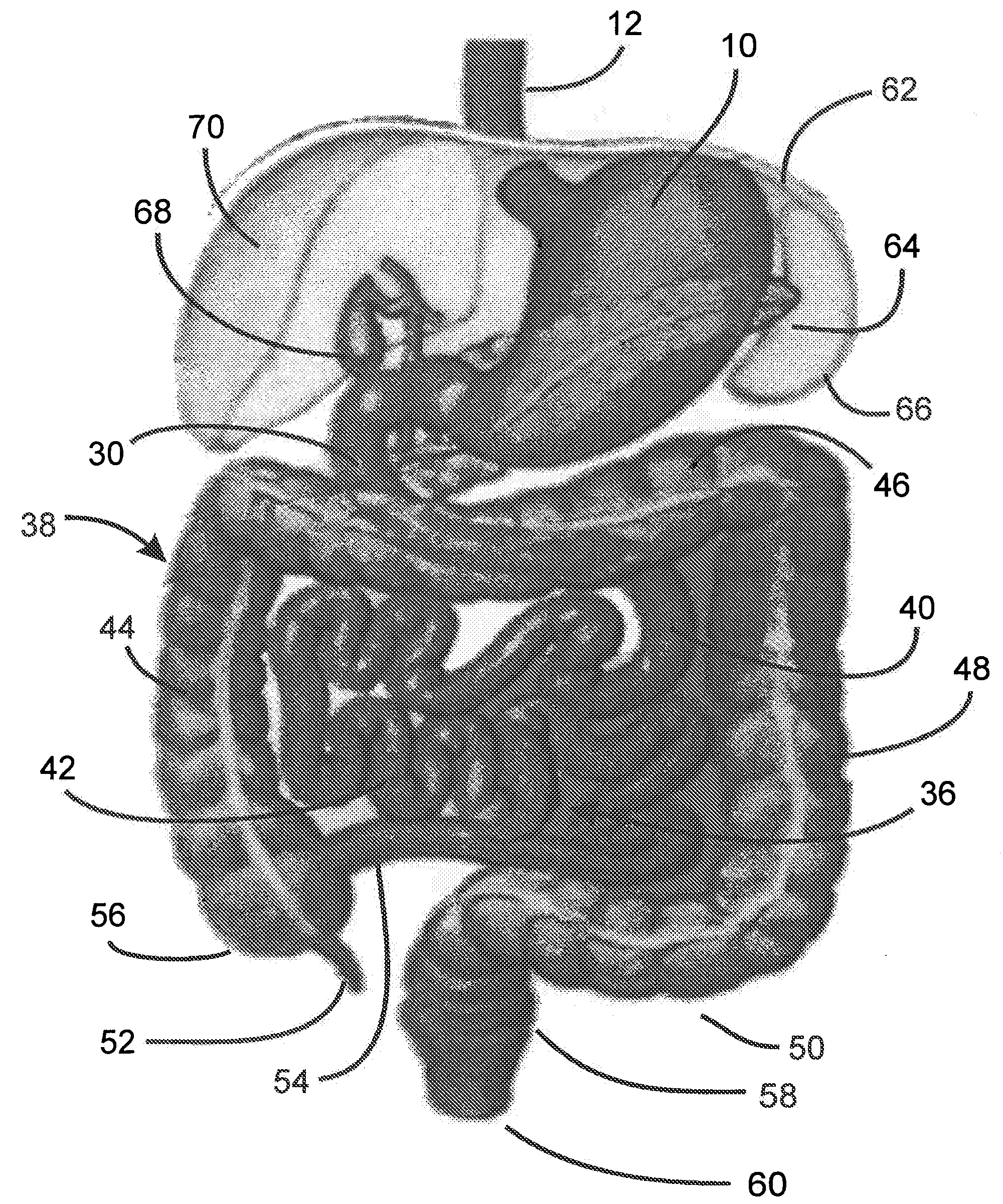 Process for electrostimulation treatment of morbid obesity