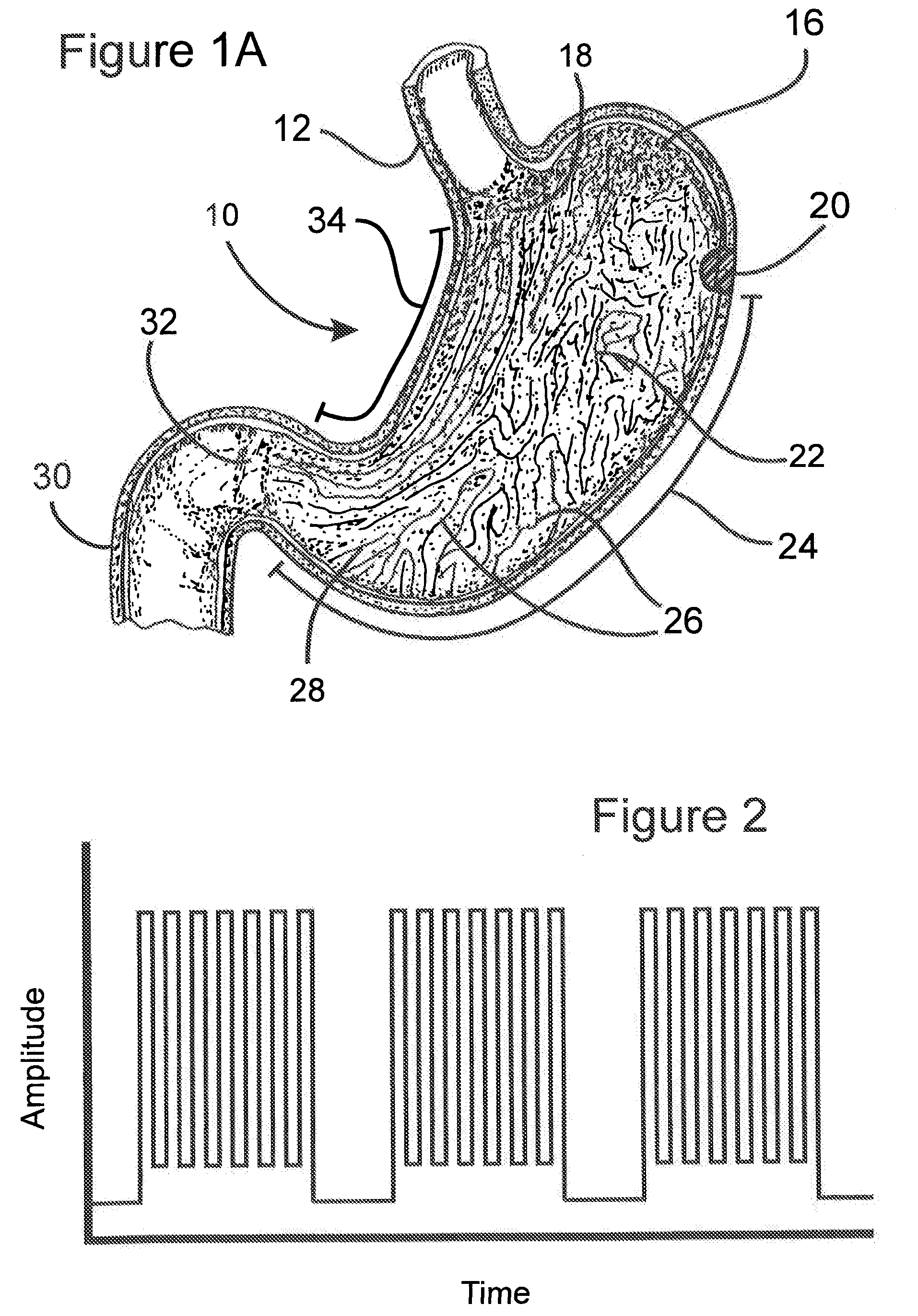 Process for electrostimulation treatment of morbid obesity