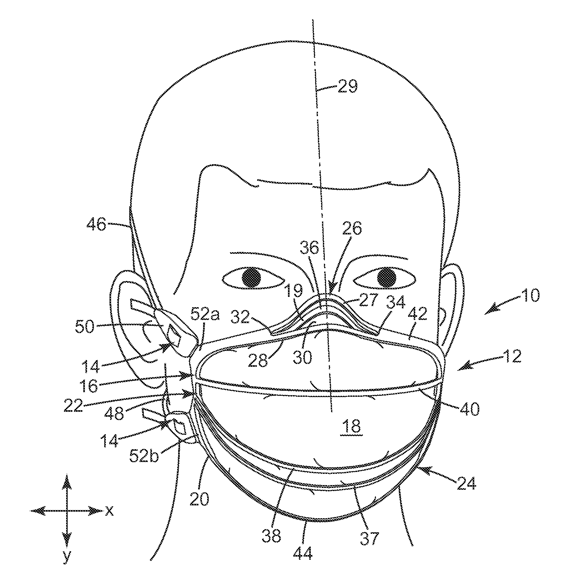 Filtering face-piece respirator having nose clip molded into the mask body