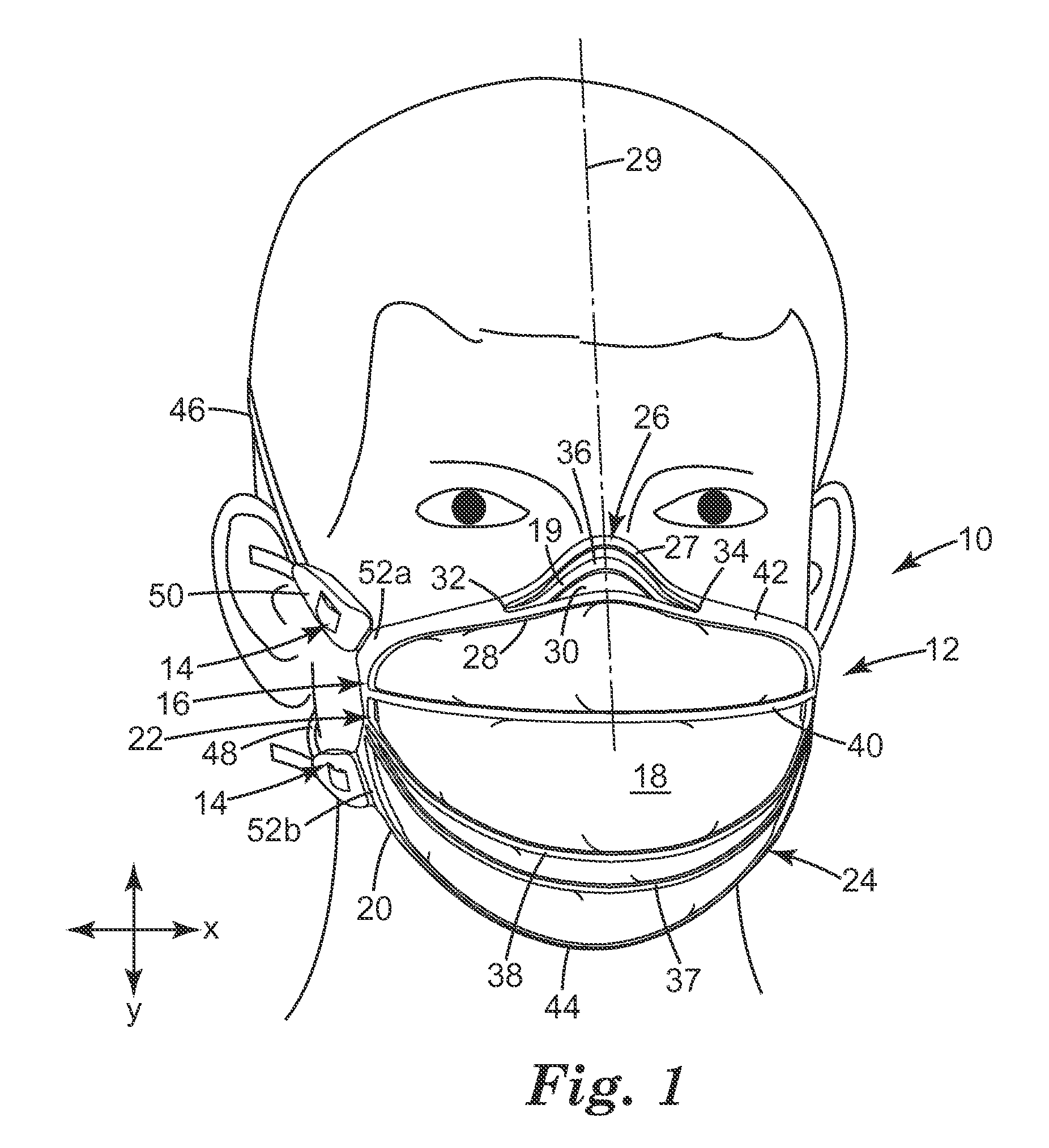 Filtering face-piece respirator having nose clip molded into the mask body
