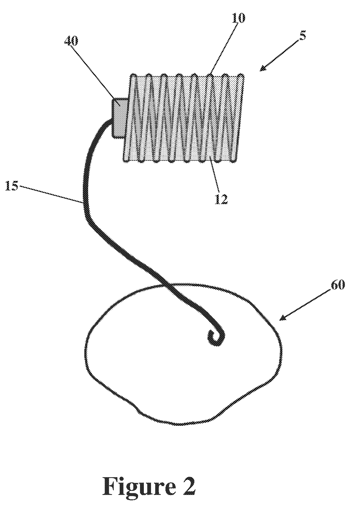 Continuous implantable peritoneal dialysis