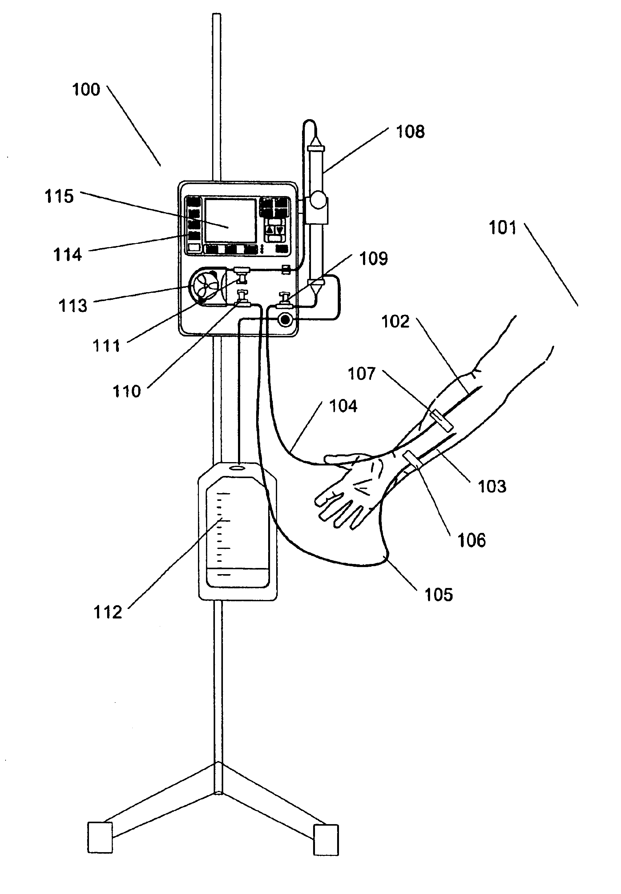 Method and apparatus for vein fluid removal in heart failure