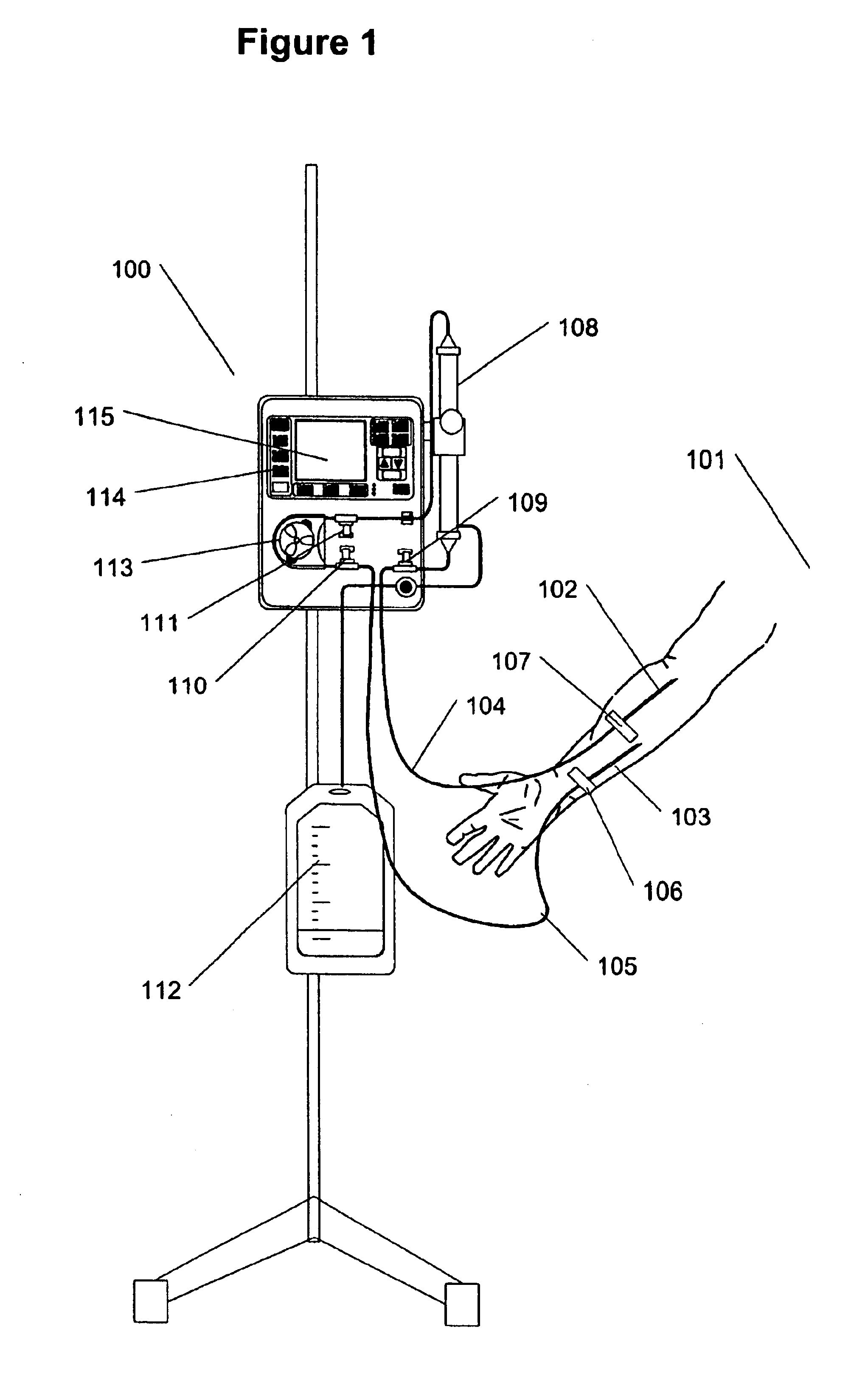 Method and apparatus for vein fluid removal in heart failure