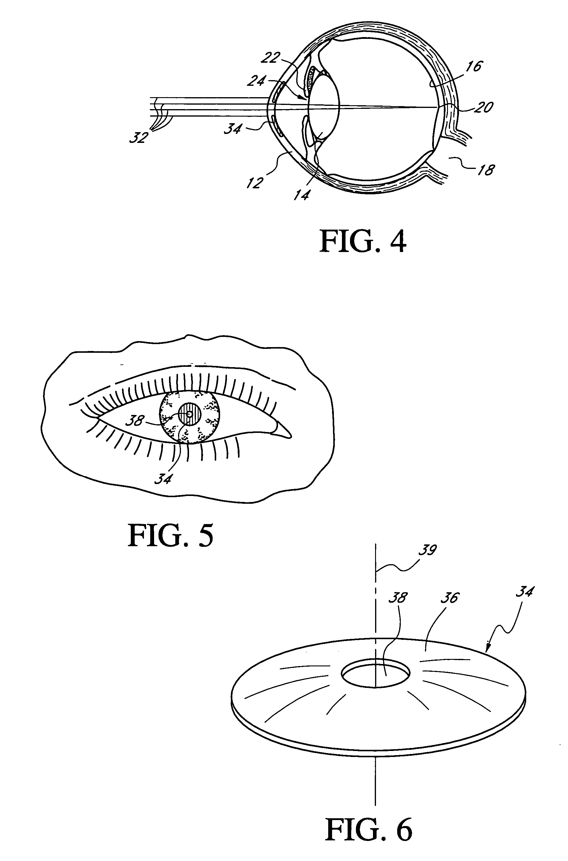Ocular inlay with locator