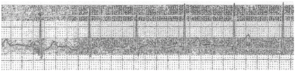 Fiber sensor suitable for electrocardiogram and respiratory signal detection