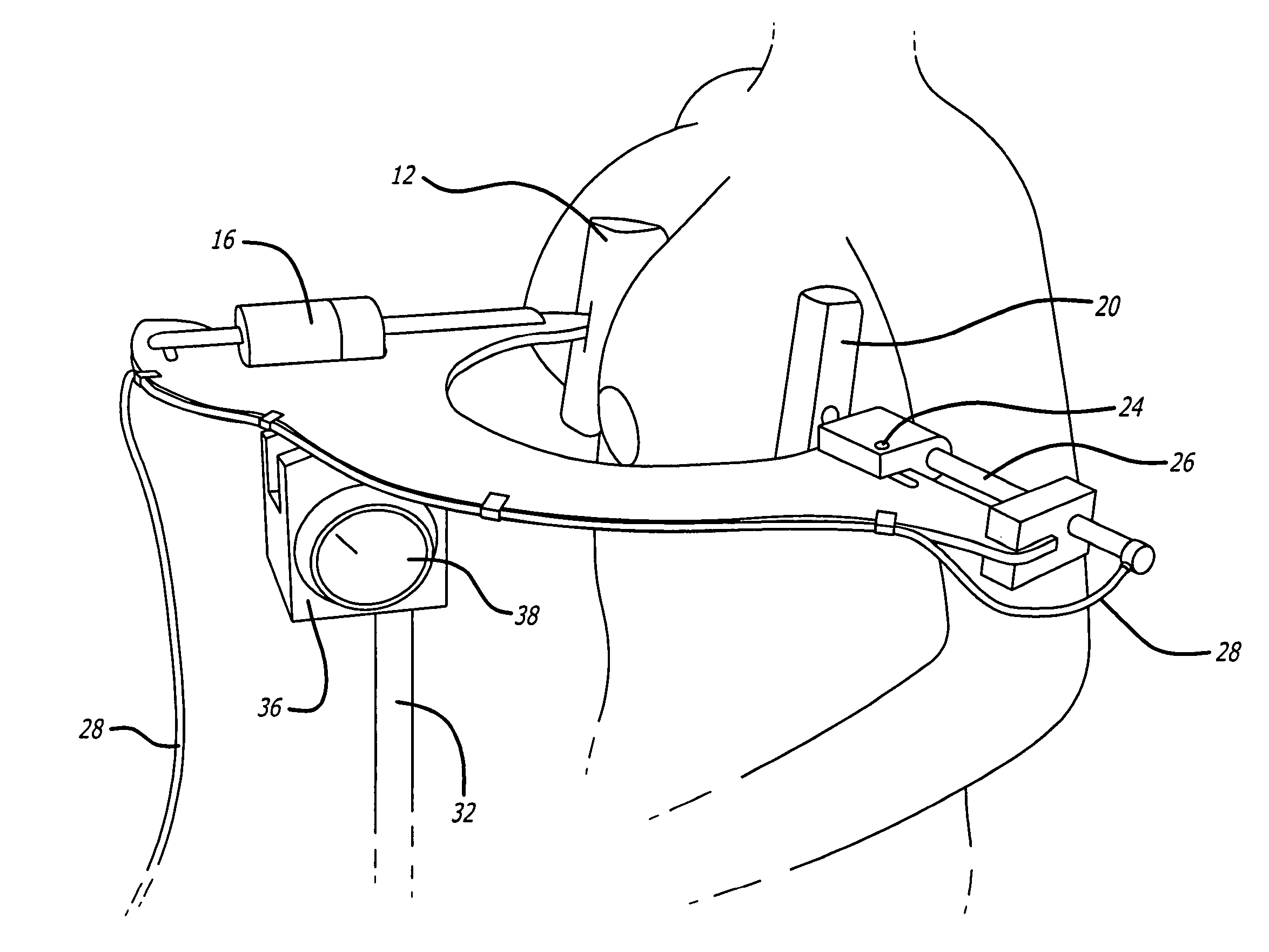 Capsular contracture preventing and relieving device