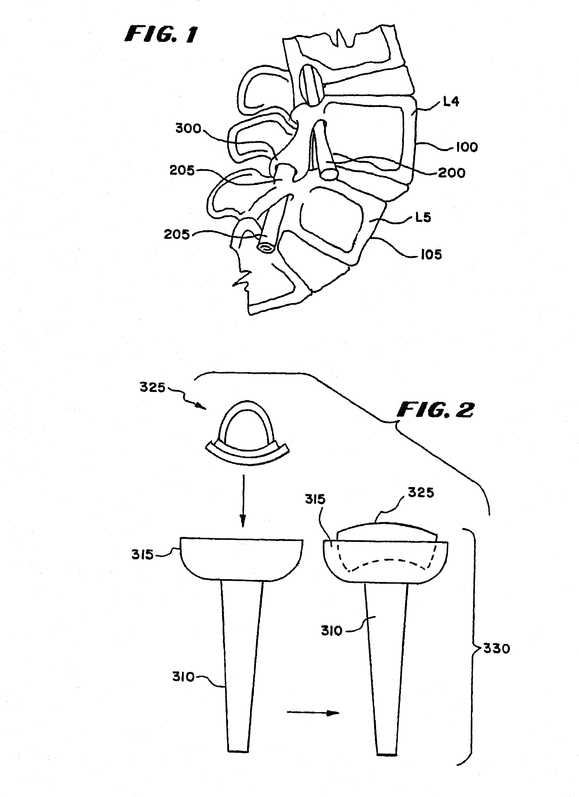 Facet arthroplasty devices and methods