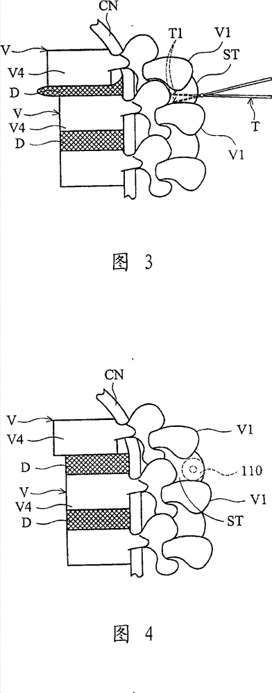 Dynamic stabilizing device for vertebra