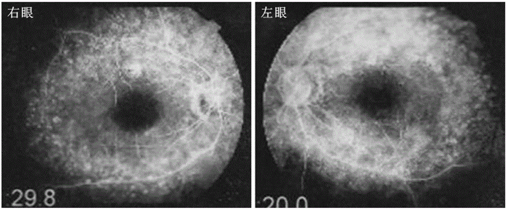 Pathogenic mutation of genetic Usher syndrome and detection reagent thereof