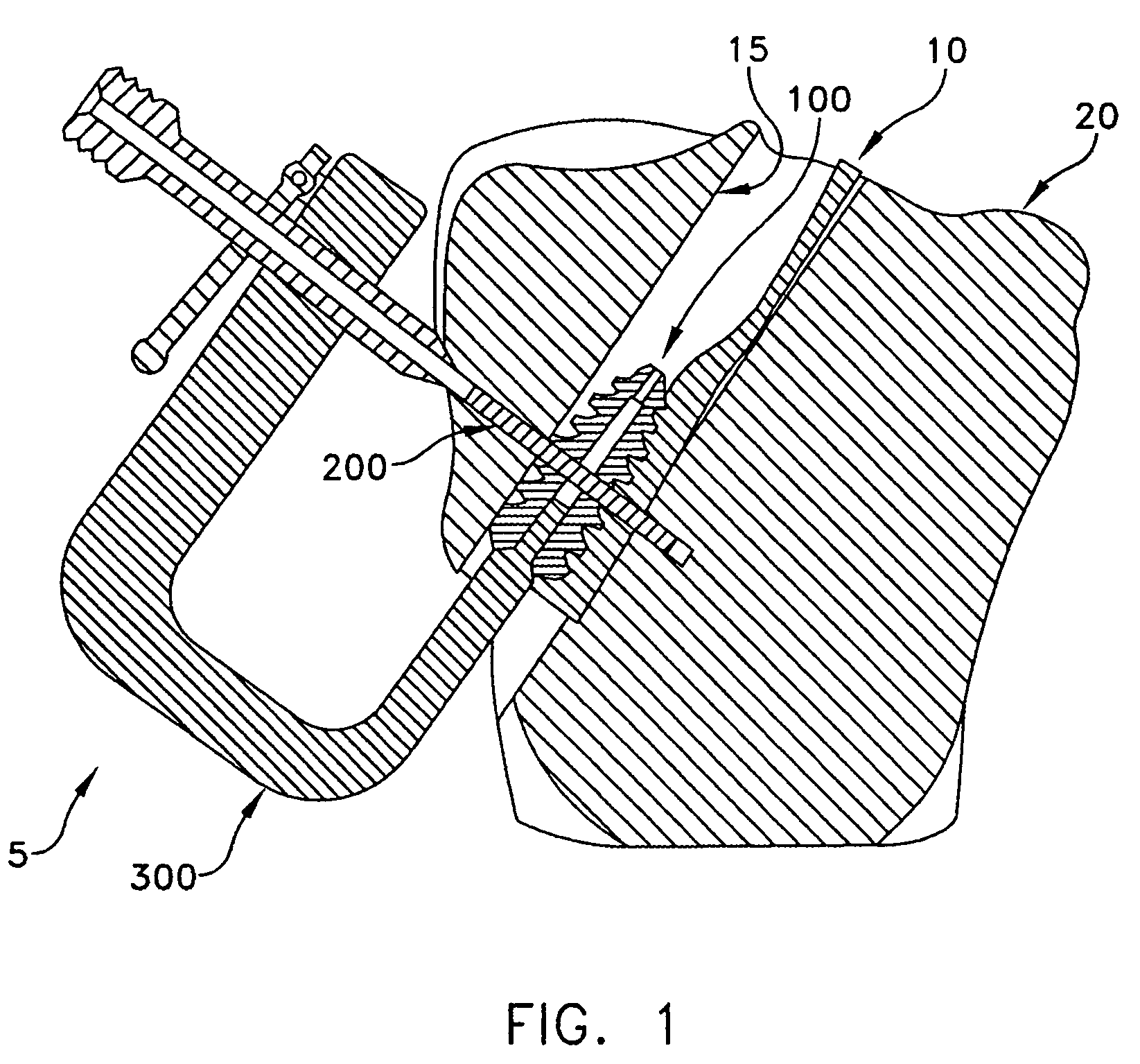 Apparatus and method for attaching a graft ligament to a bone