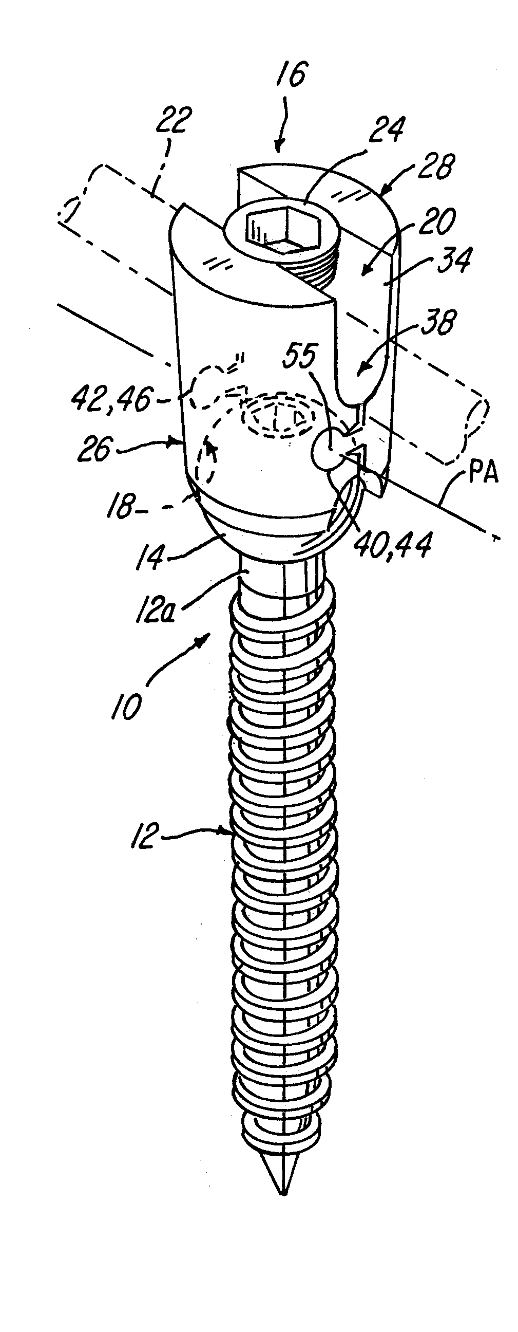 Polyaxial screw system and method having a hinged receiver