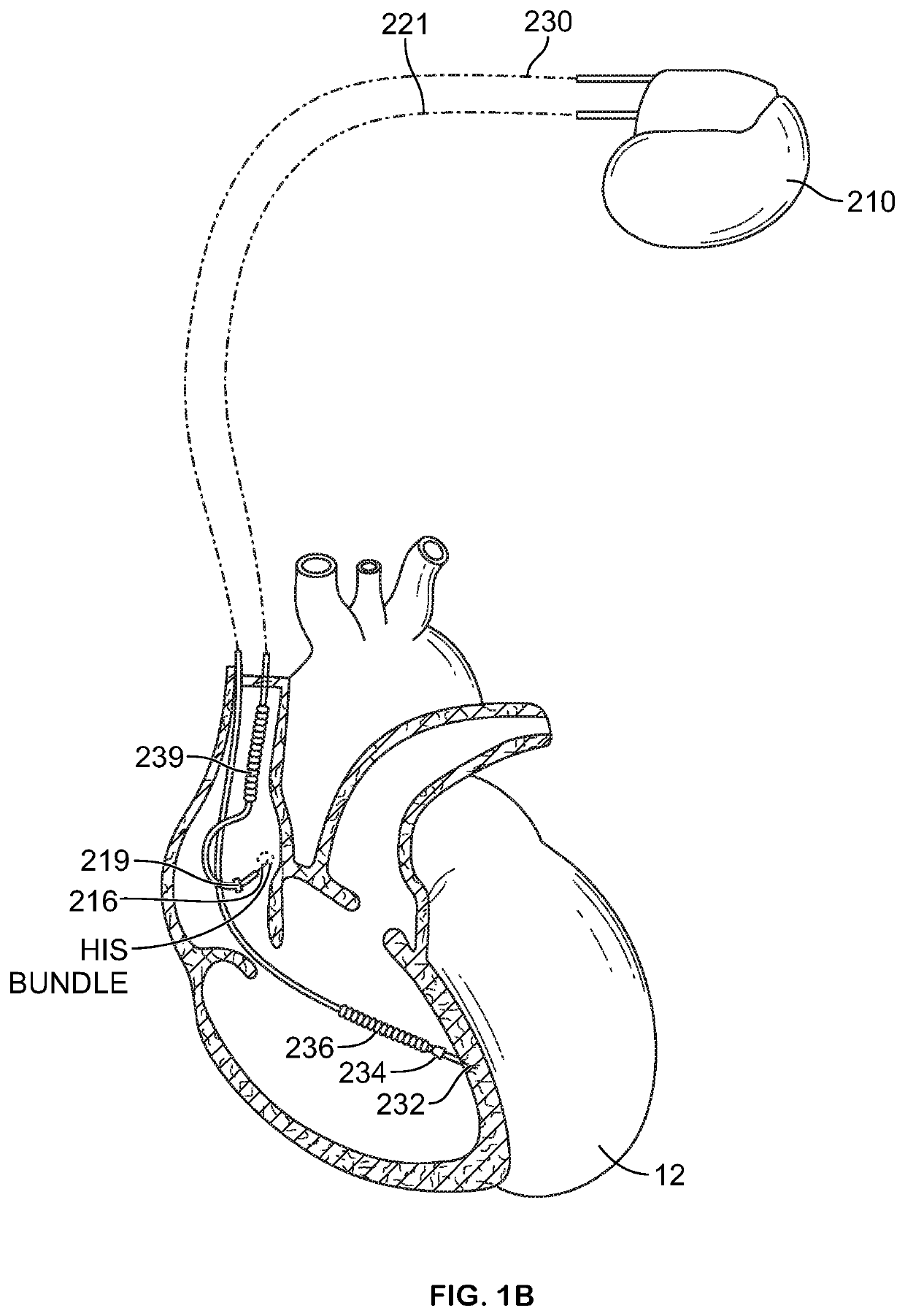 Systems and methods for managing atrial-ventricular delay adjustments