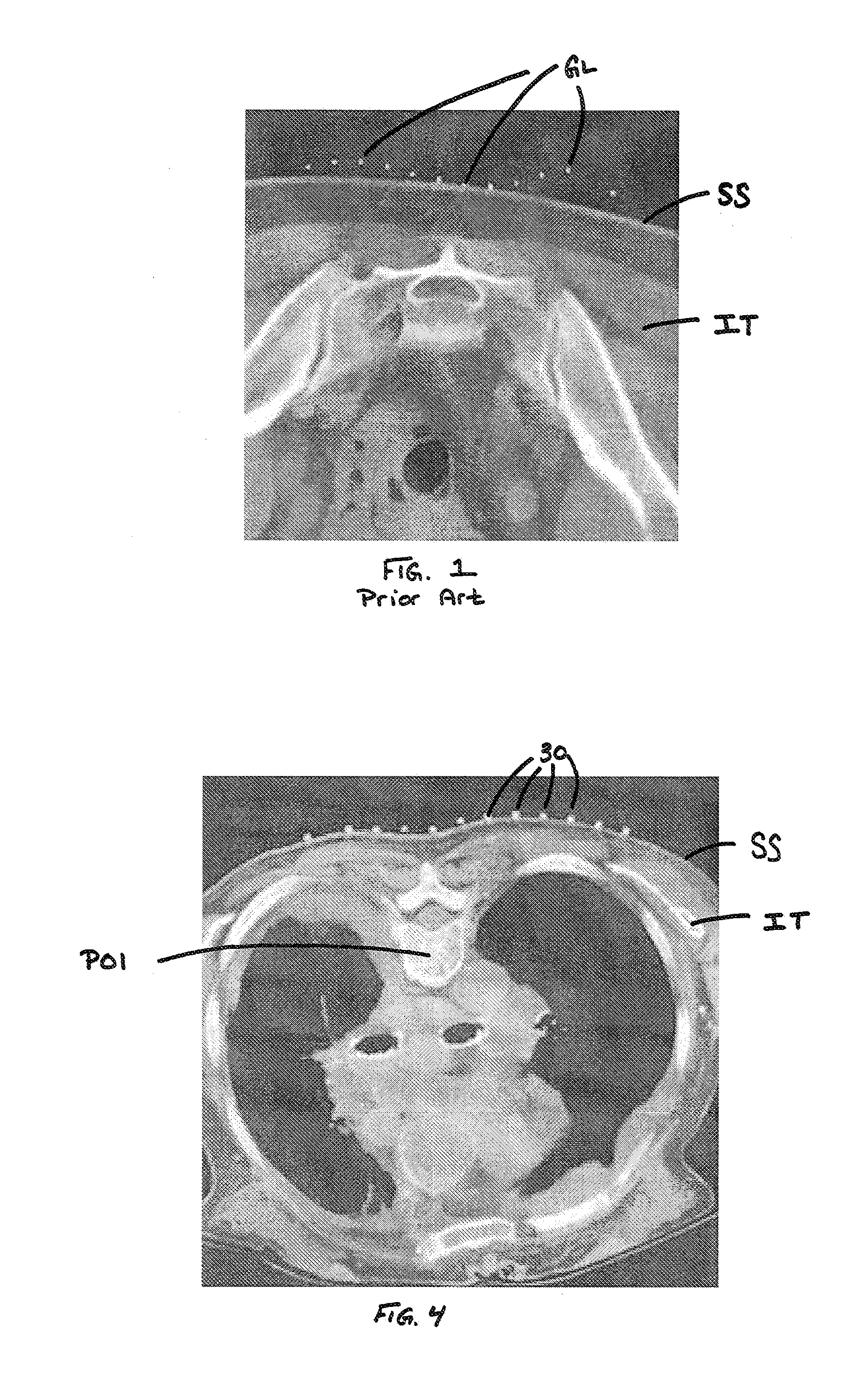 Skin Marking Porous Grid and Related Method of Use