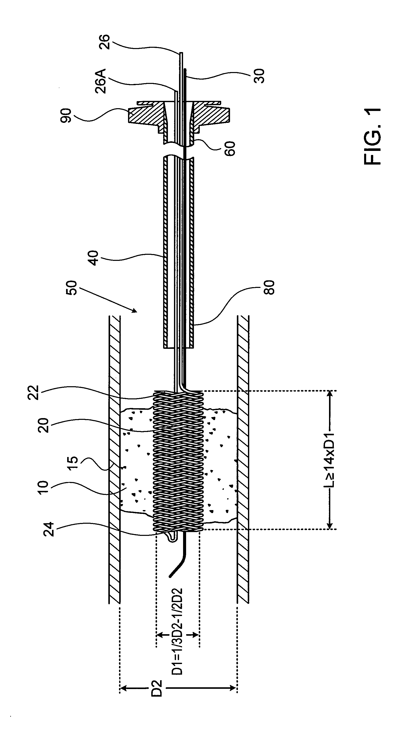 Method and apparatus for allowing blood flow through an occluded vessel