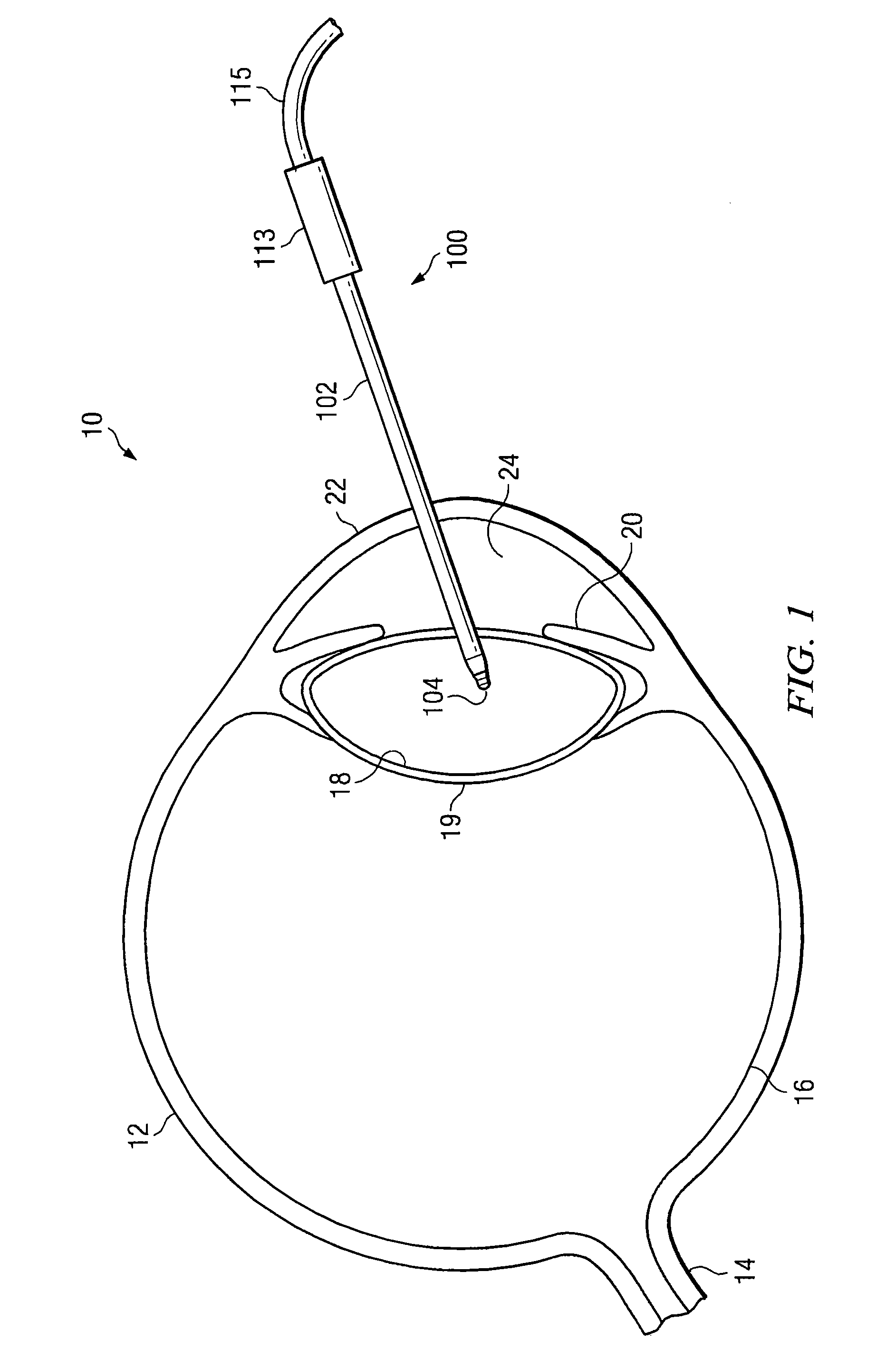 Distal plastic end infusion/aspiration tip