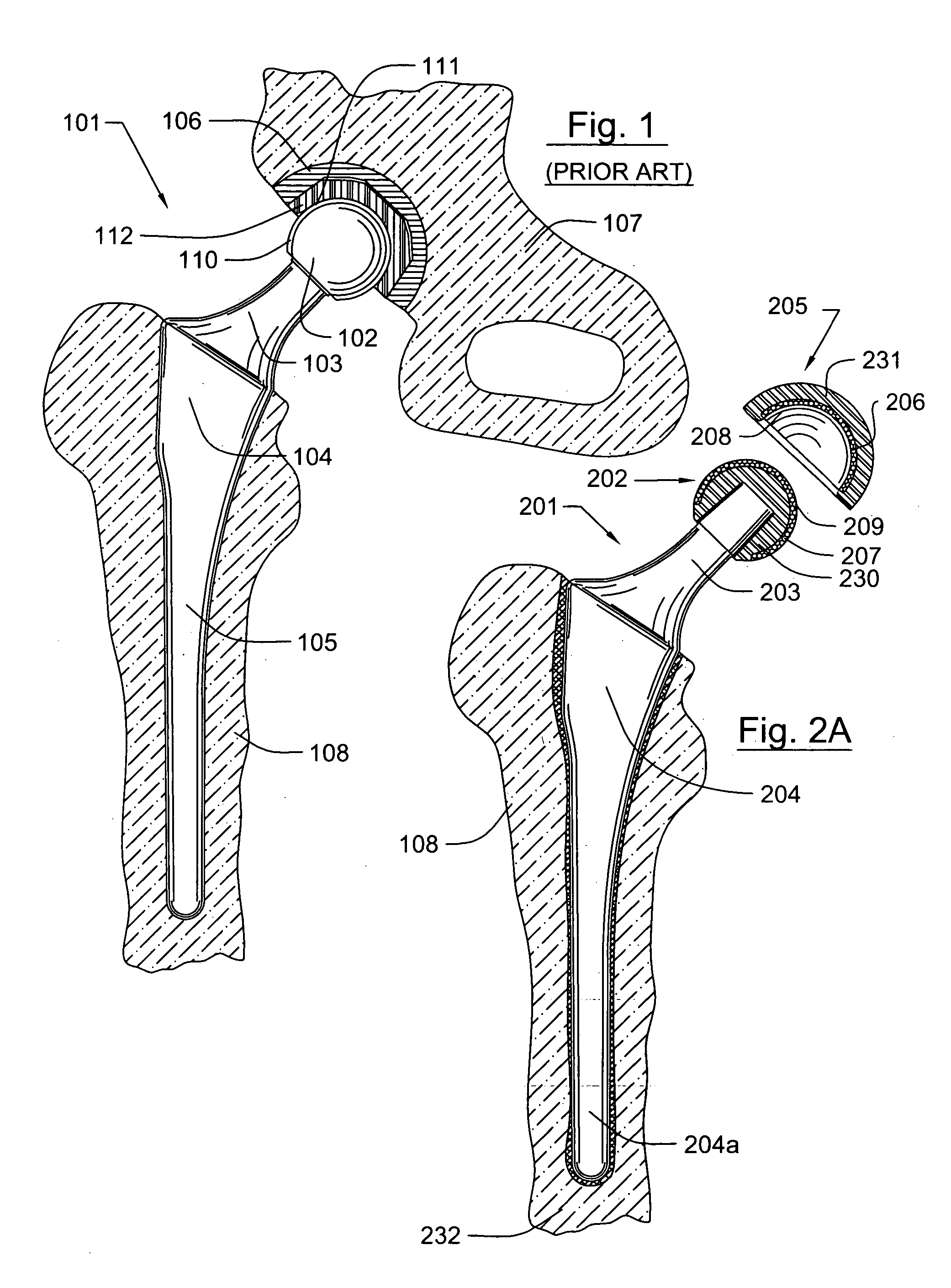 Prosthetic knee joint having at least one diamond articulation surface