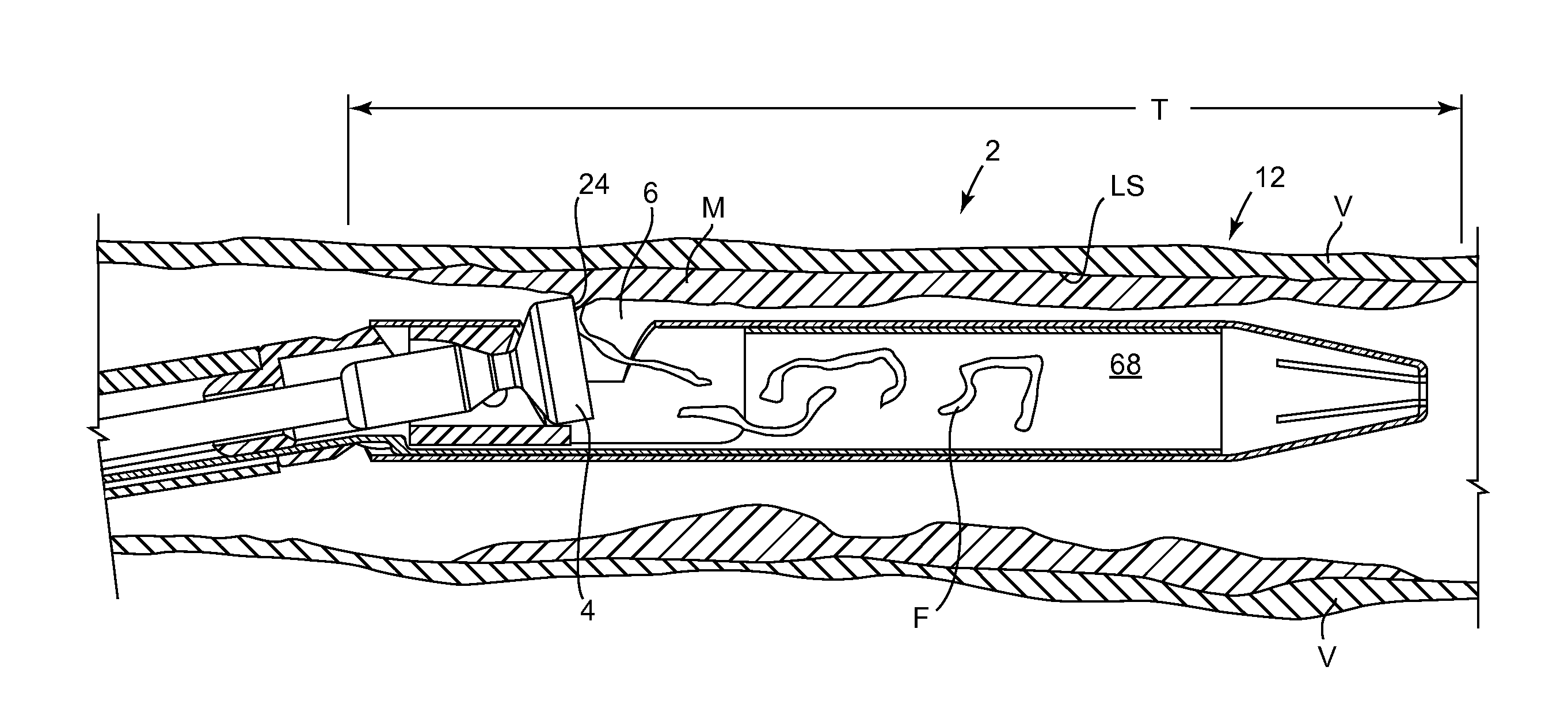 Easily cleaned atherectomy catheters and methods of use