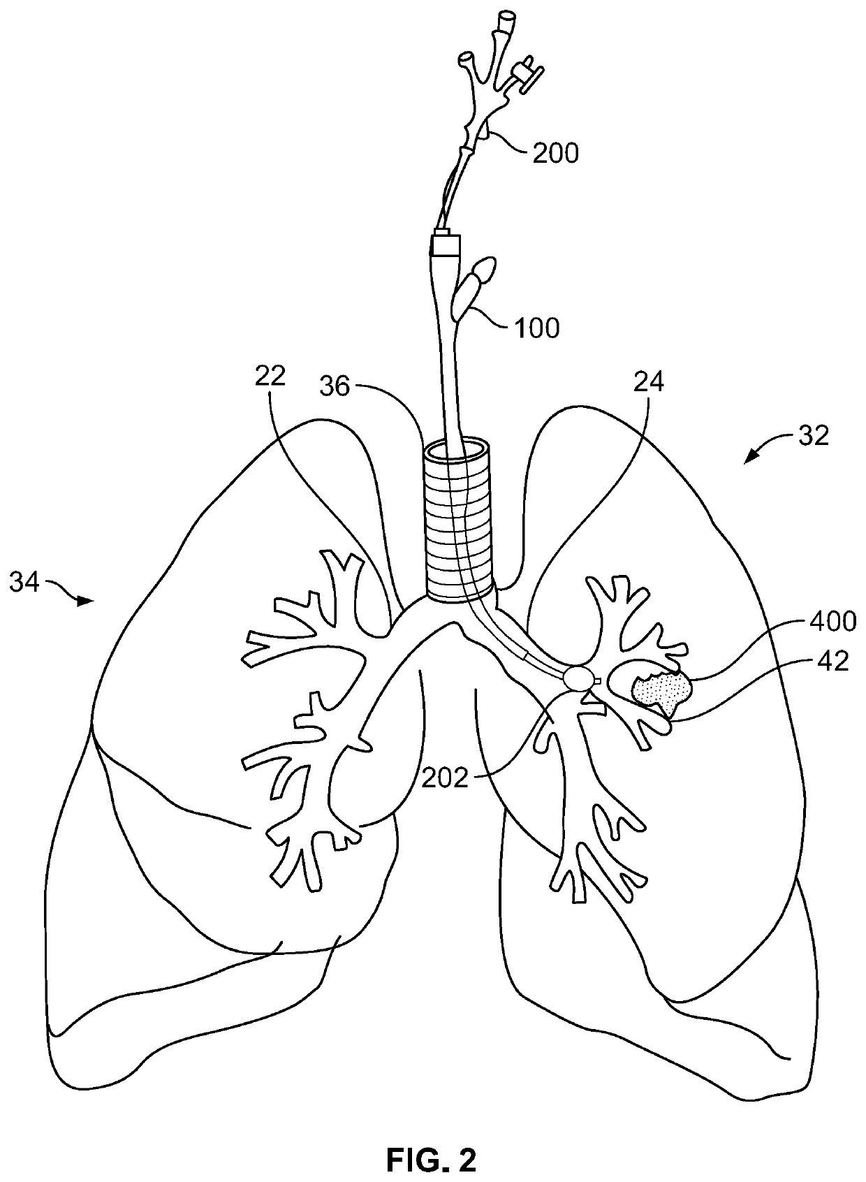 Bronchoscopic multimodality lung tumor treatment