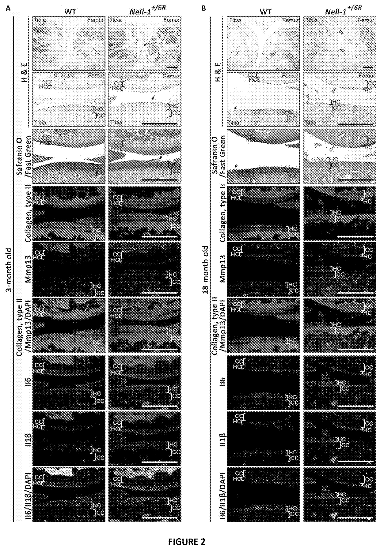 Composition and method for arthritis