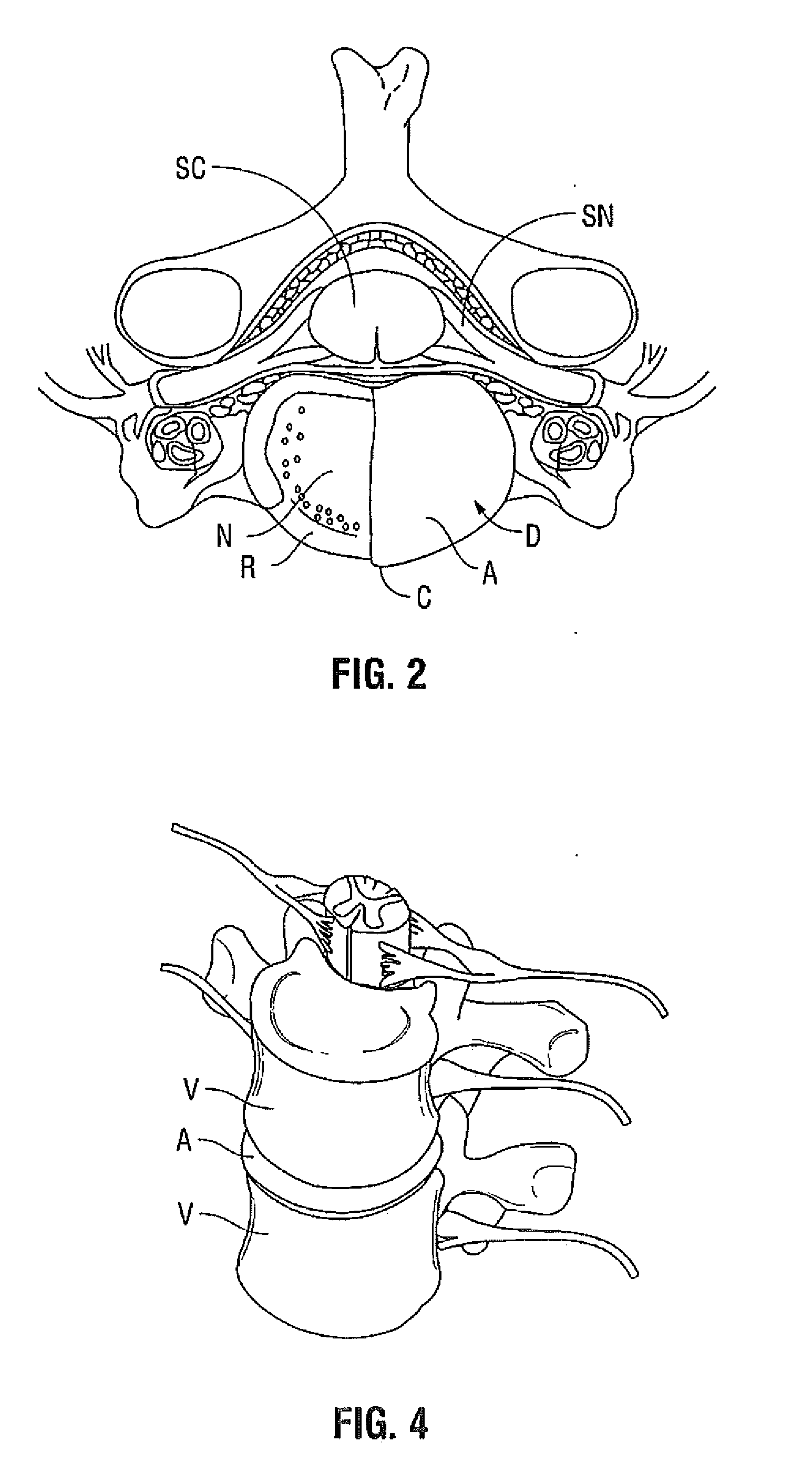 Method for Treatment of an Intervertebral Disc