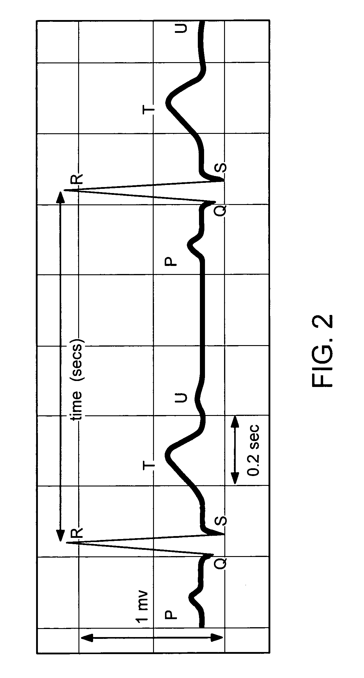 Method and system for detecting premature ventricular contraction from a surface electrocardiogram