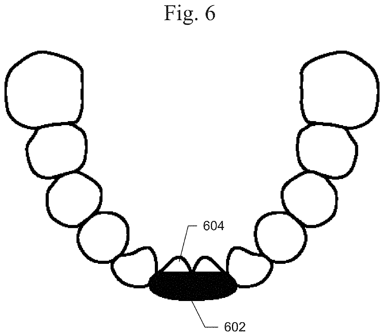 Process for fabricating a digital bite opening appliance during orthodontic treatment