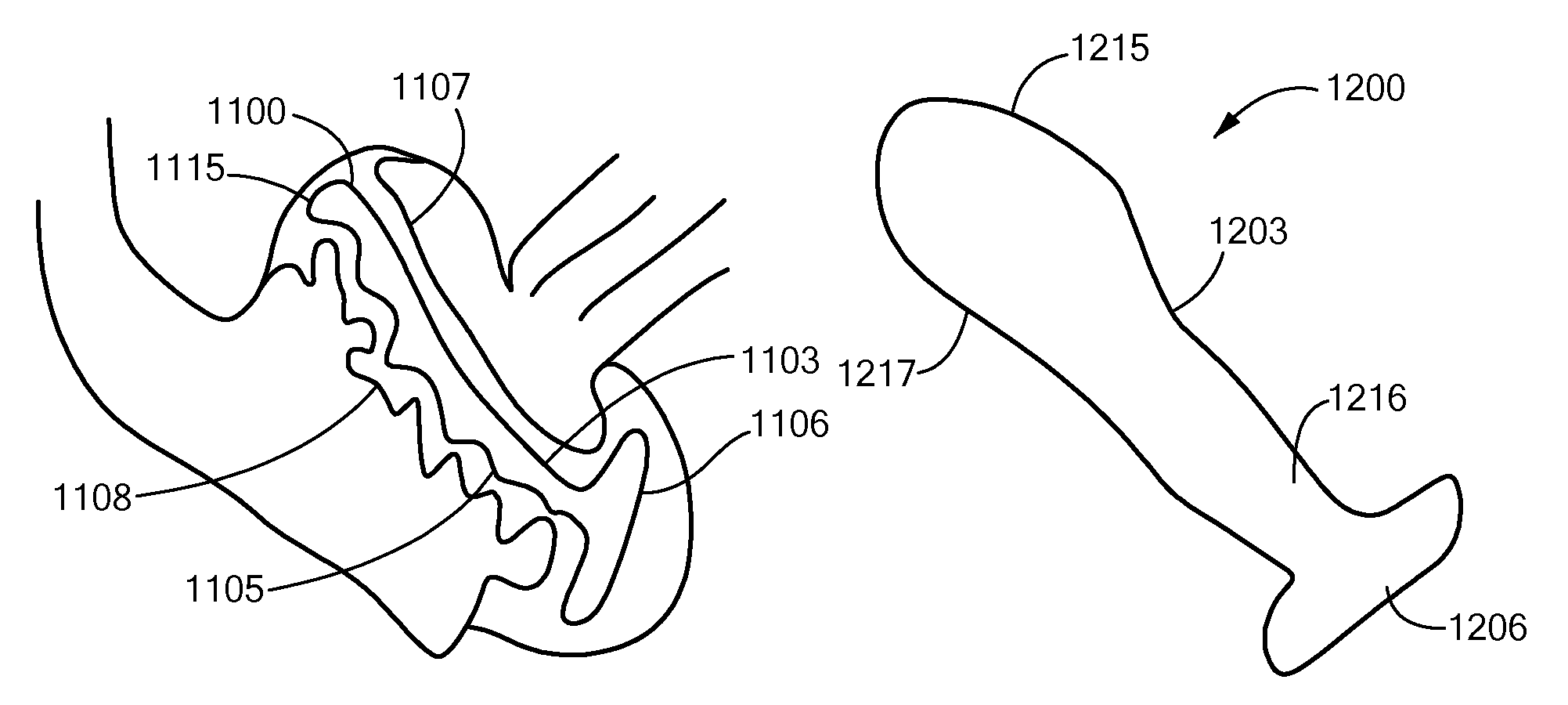 Devices and methods for treatment of facet and other joints
