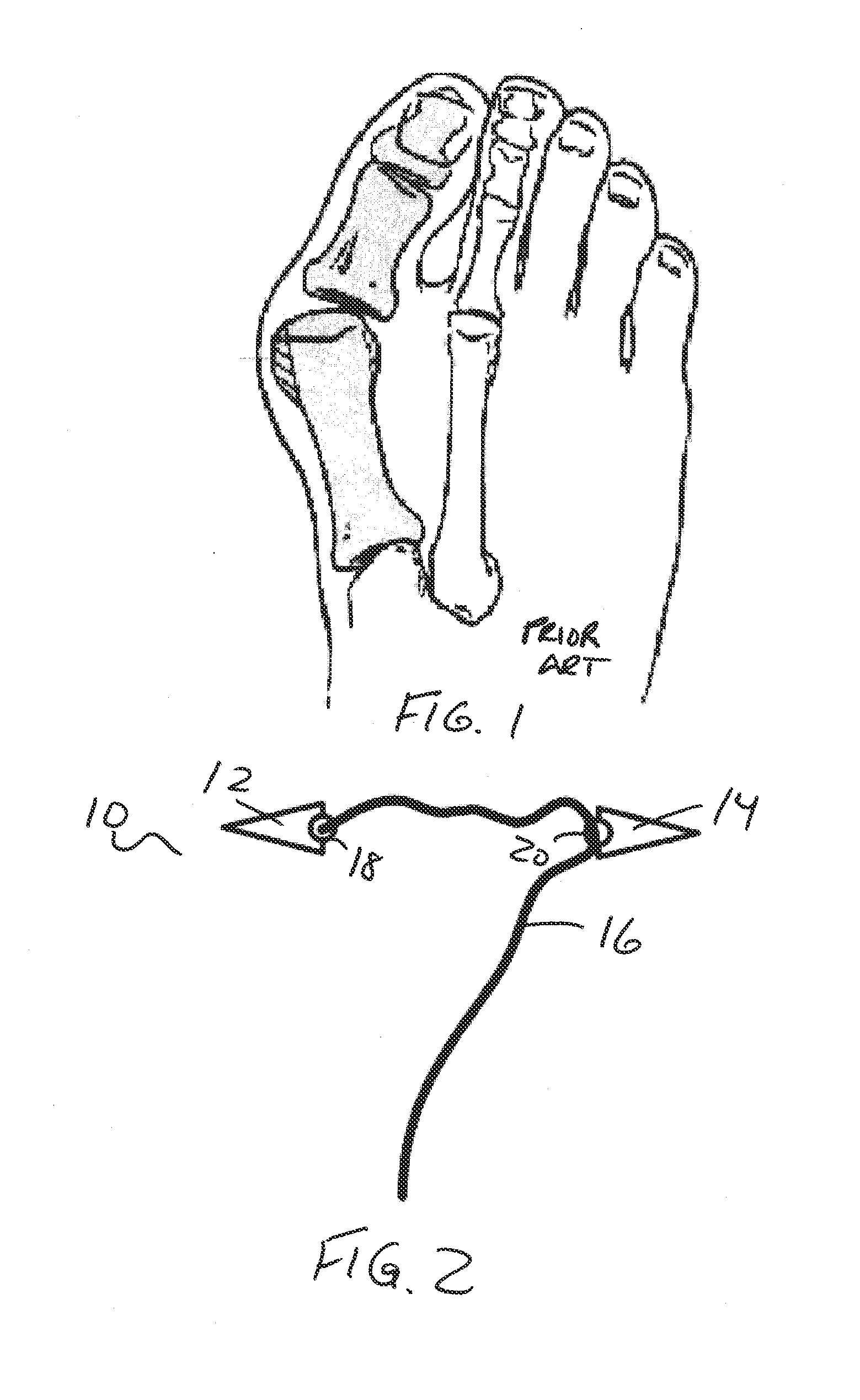 Methods and devices for treating hallux valgus