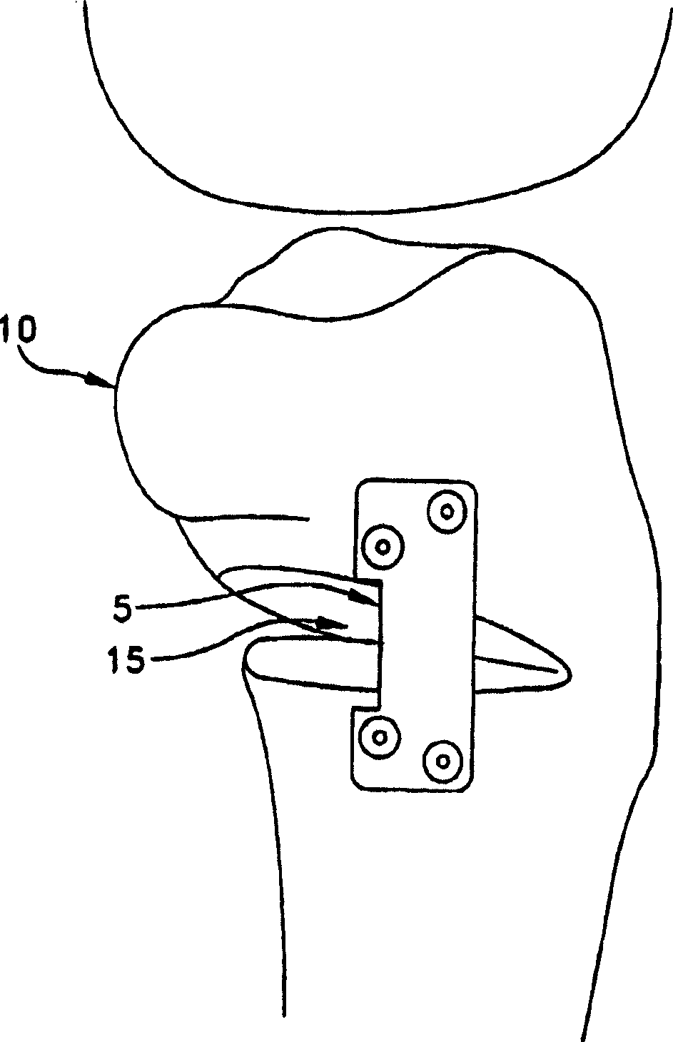 Open wedge osteotomy system and surgical method