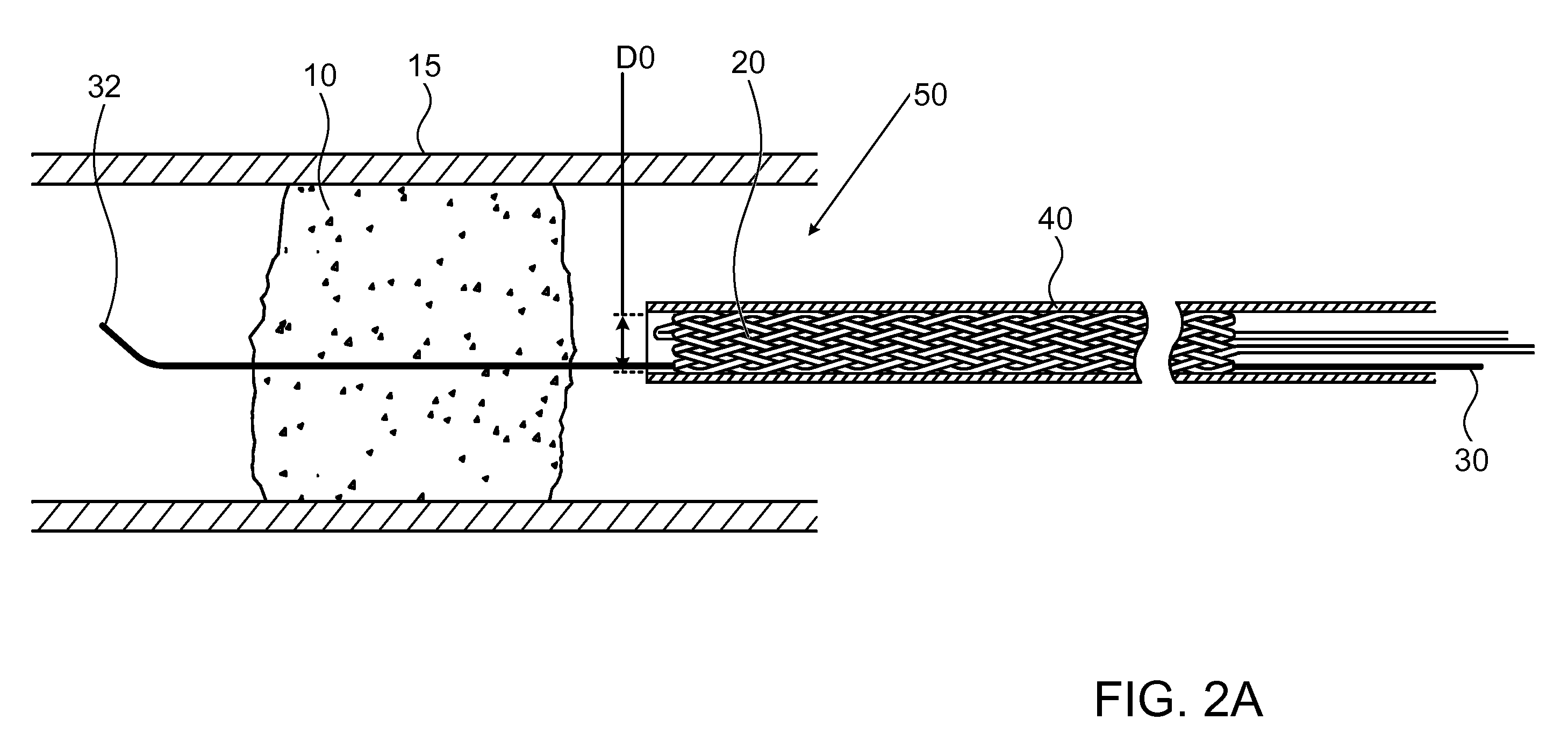 Method and apparatus for allowing blood flow through an occluded vessel