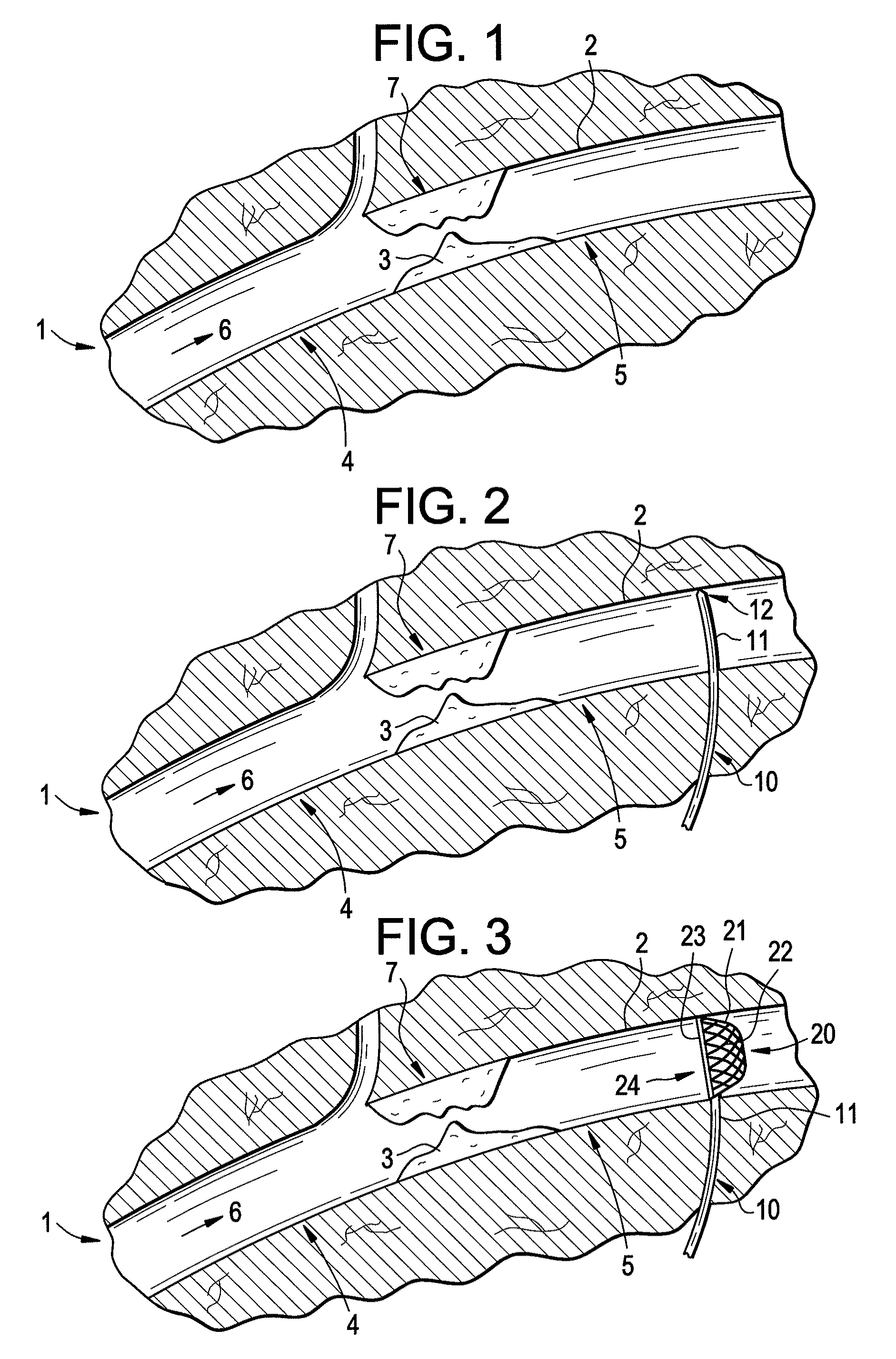 Distal access embolic protection system and methods of using the same