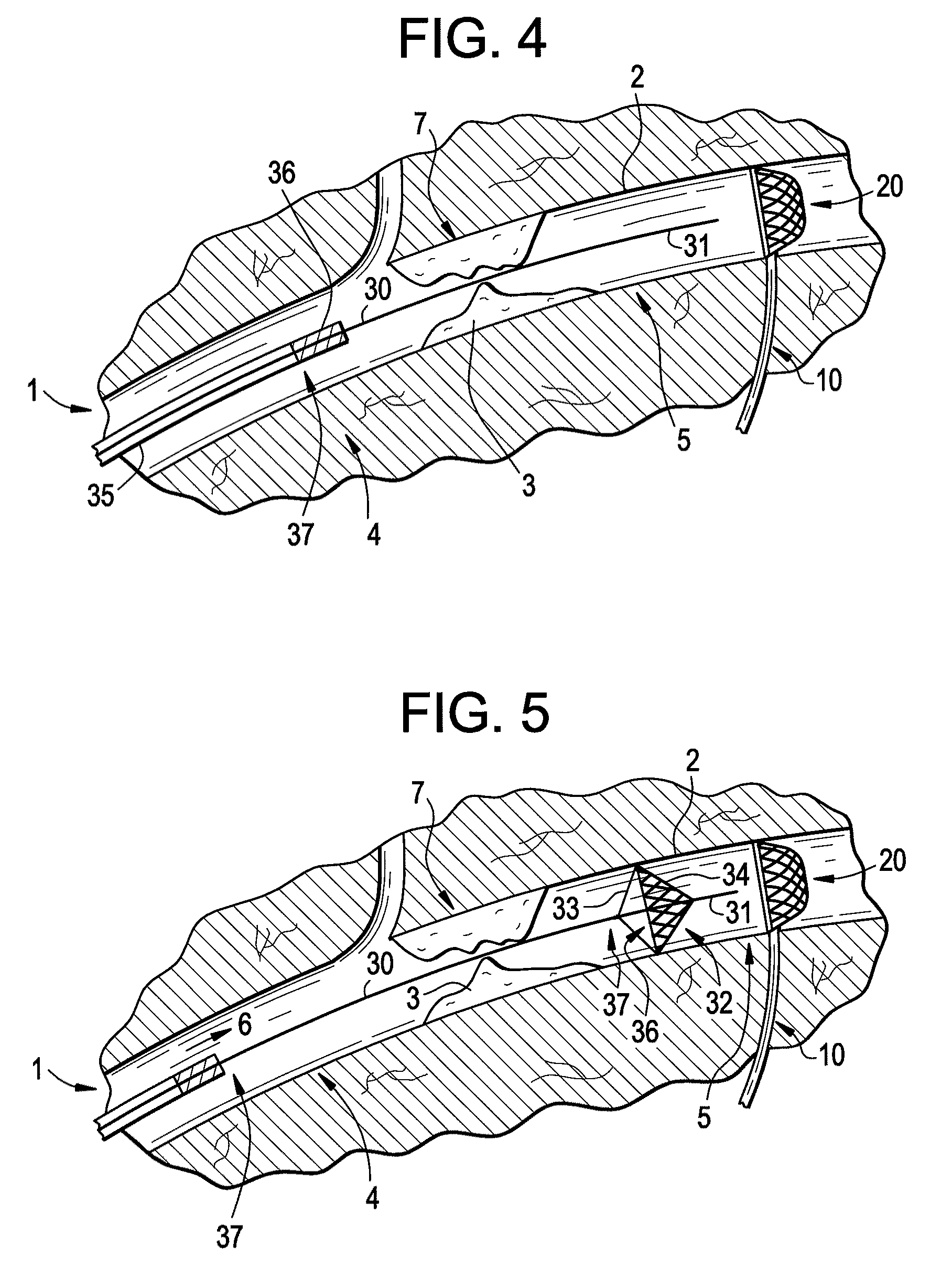 Distal access embolic protection system and methods of using the same