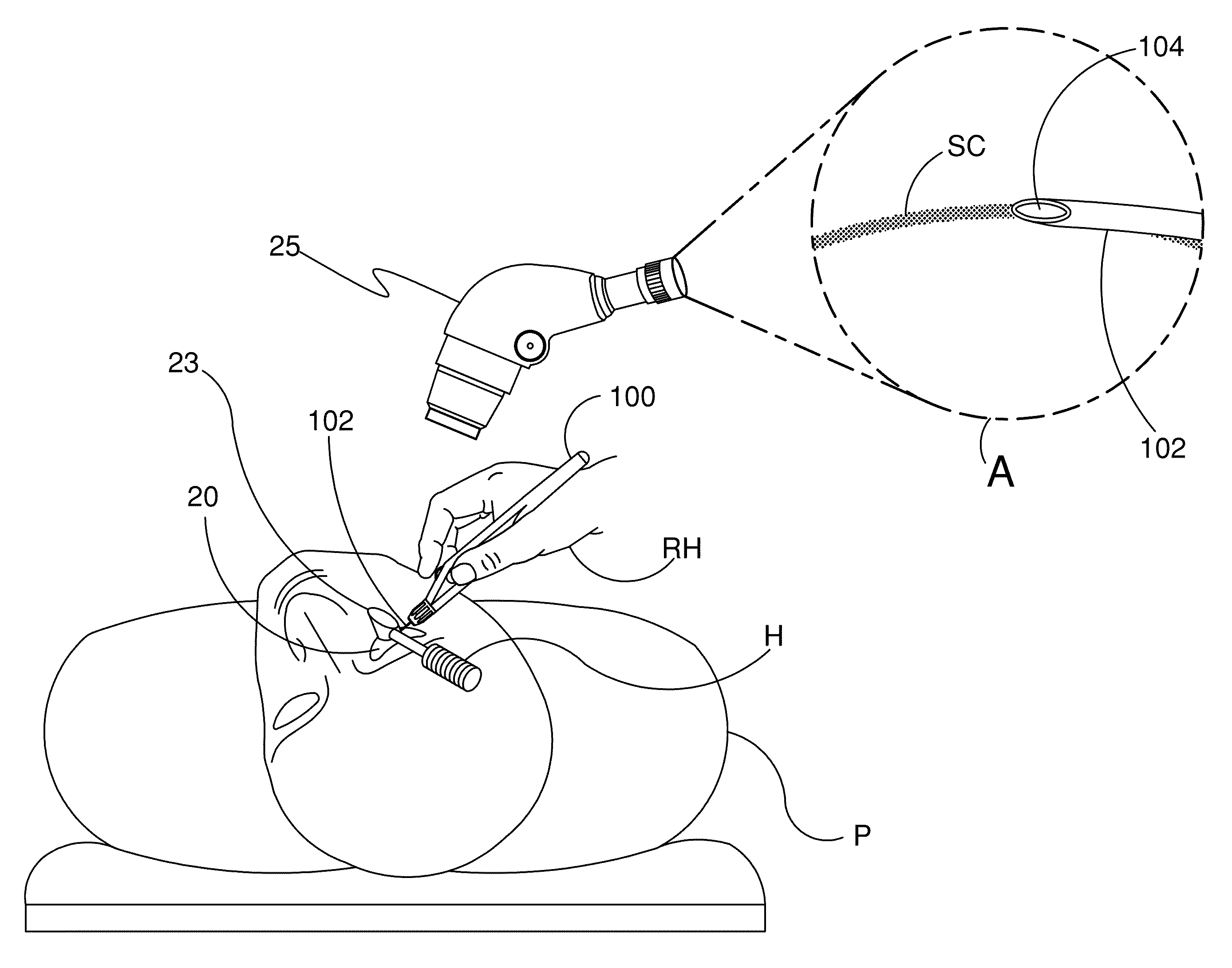 Ocular Implants and Methods for Delivering Ocular Implants Into the Eye