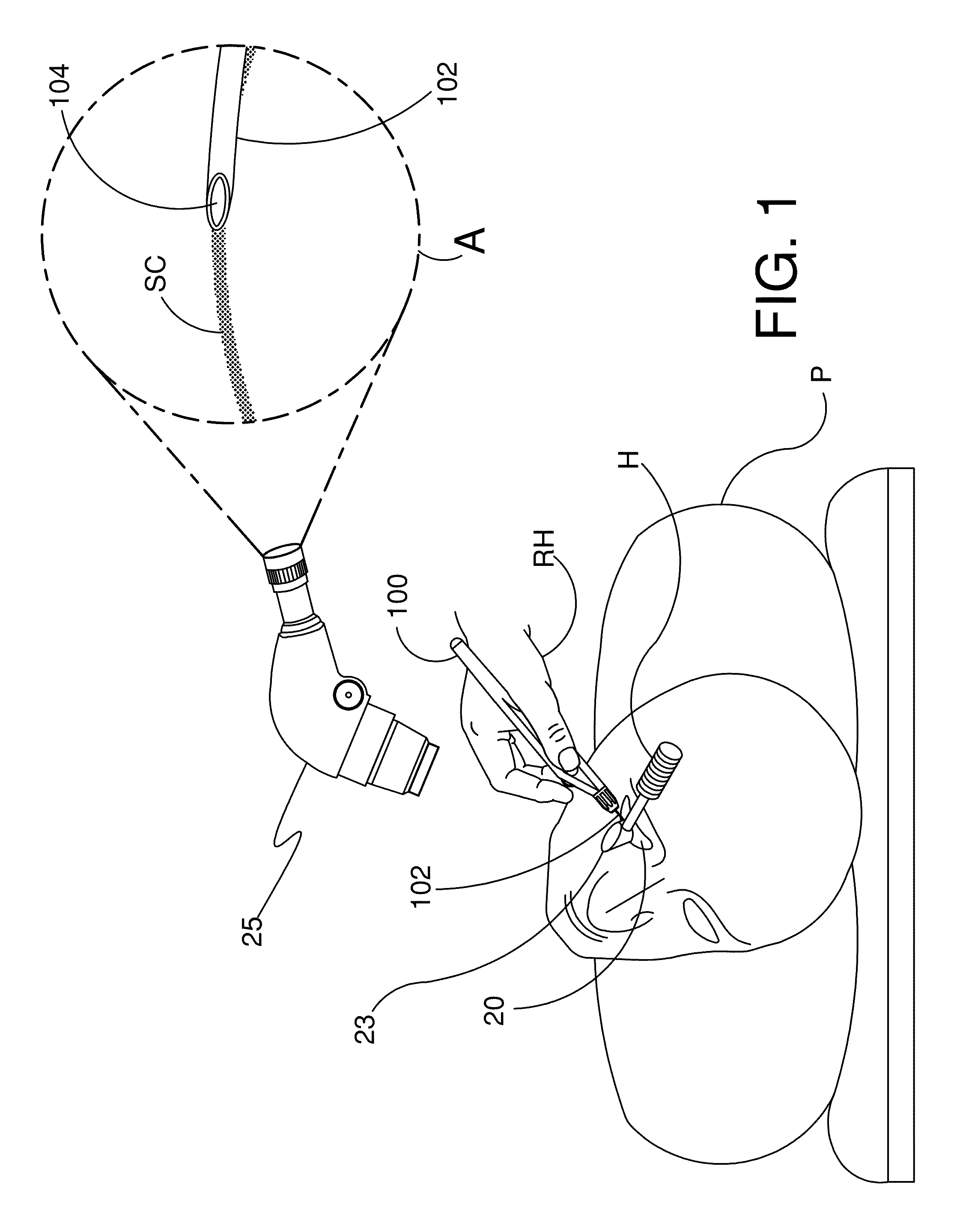 Ocular Implants and Methods for Delivering Ocular Implants Into the Eye