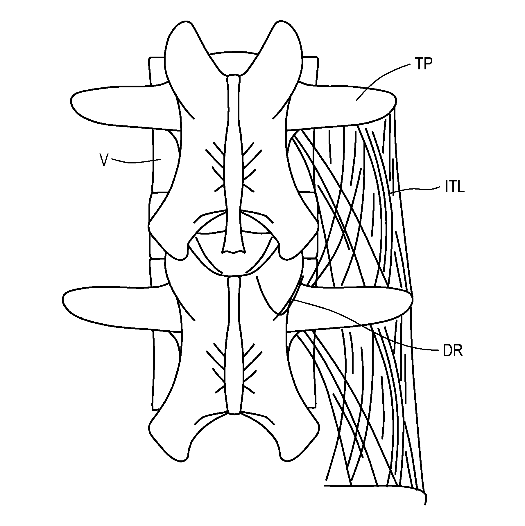 Apparatus and methods for anchoring electrode leads adjacent to nervous tissue