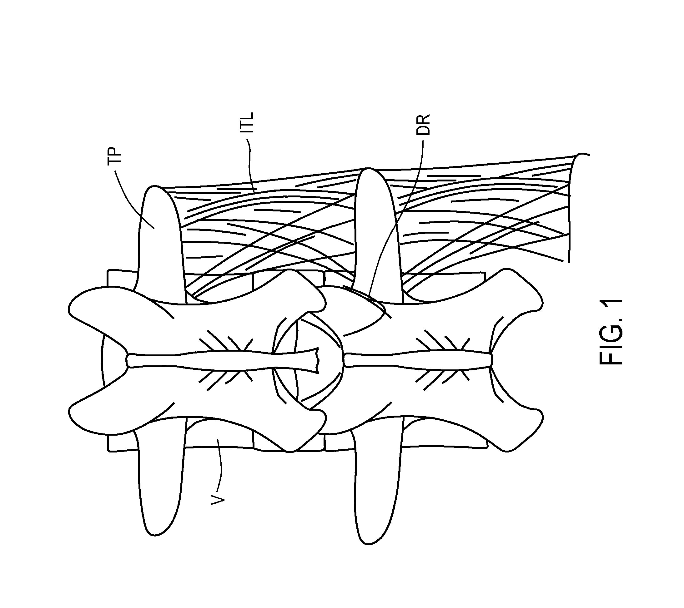 Apparatus and methods for anchoring electrode leads adjacent to nervous tissue
